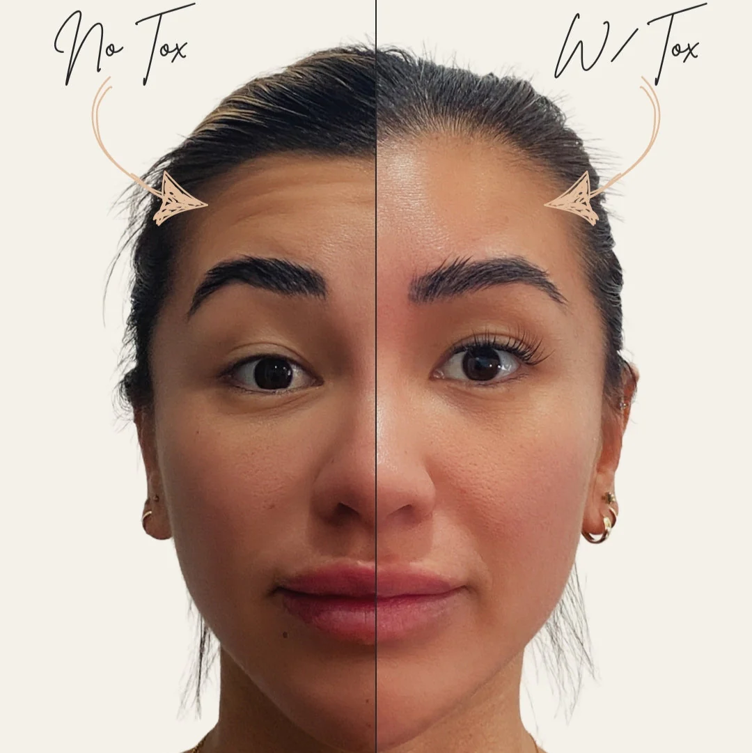 Forehead TOX - Image 3