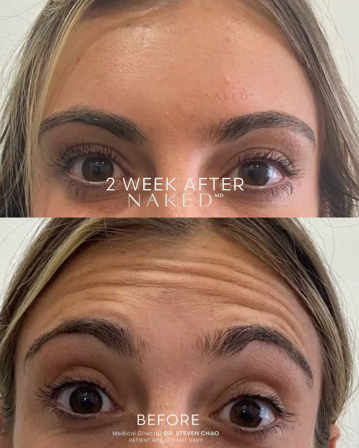 Forehead TOX - Image 5