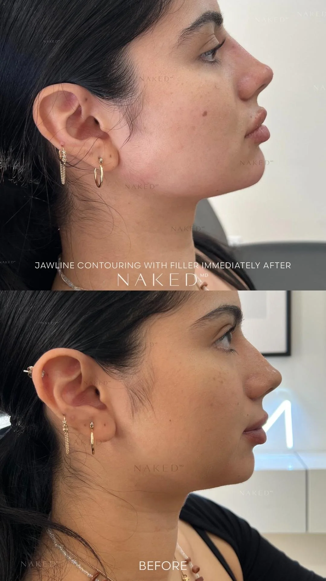 Jawline Contour Filler - Image 4