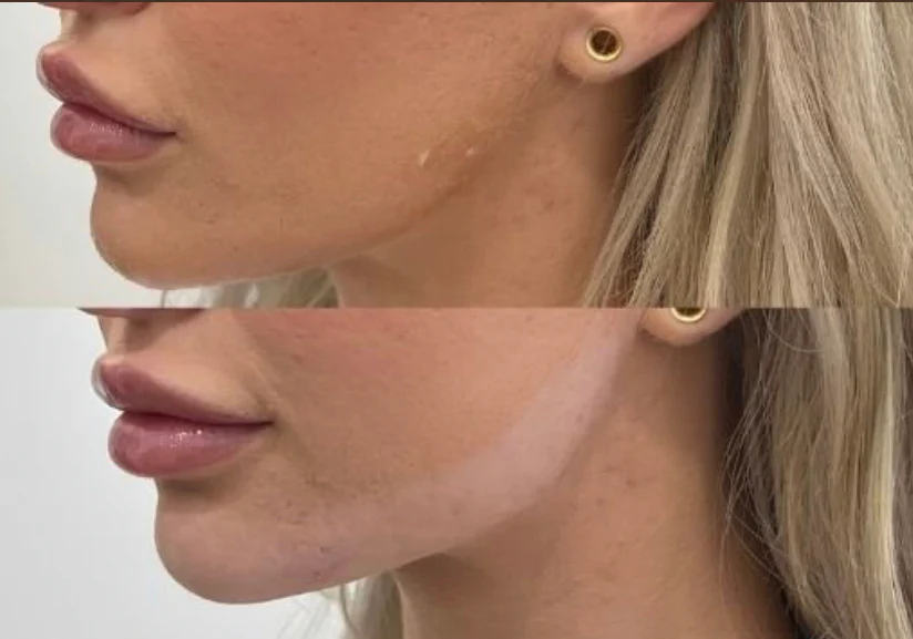 Jawline Contour Filler - Image 6