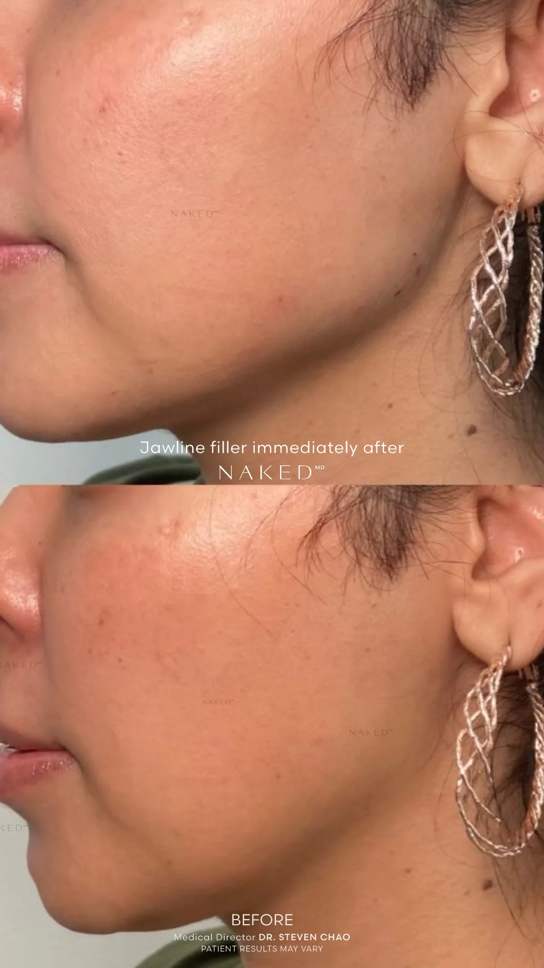 Jawline Contour Filler - Image 8