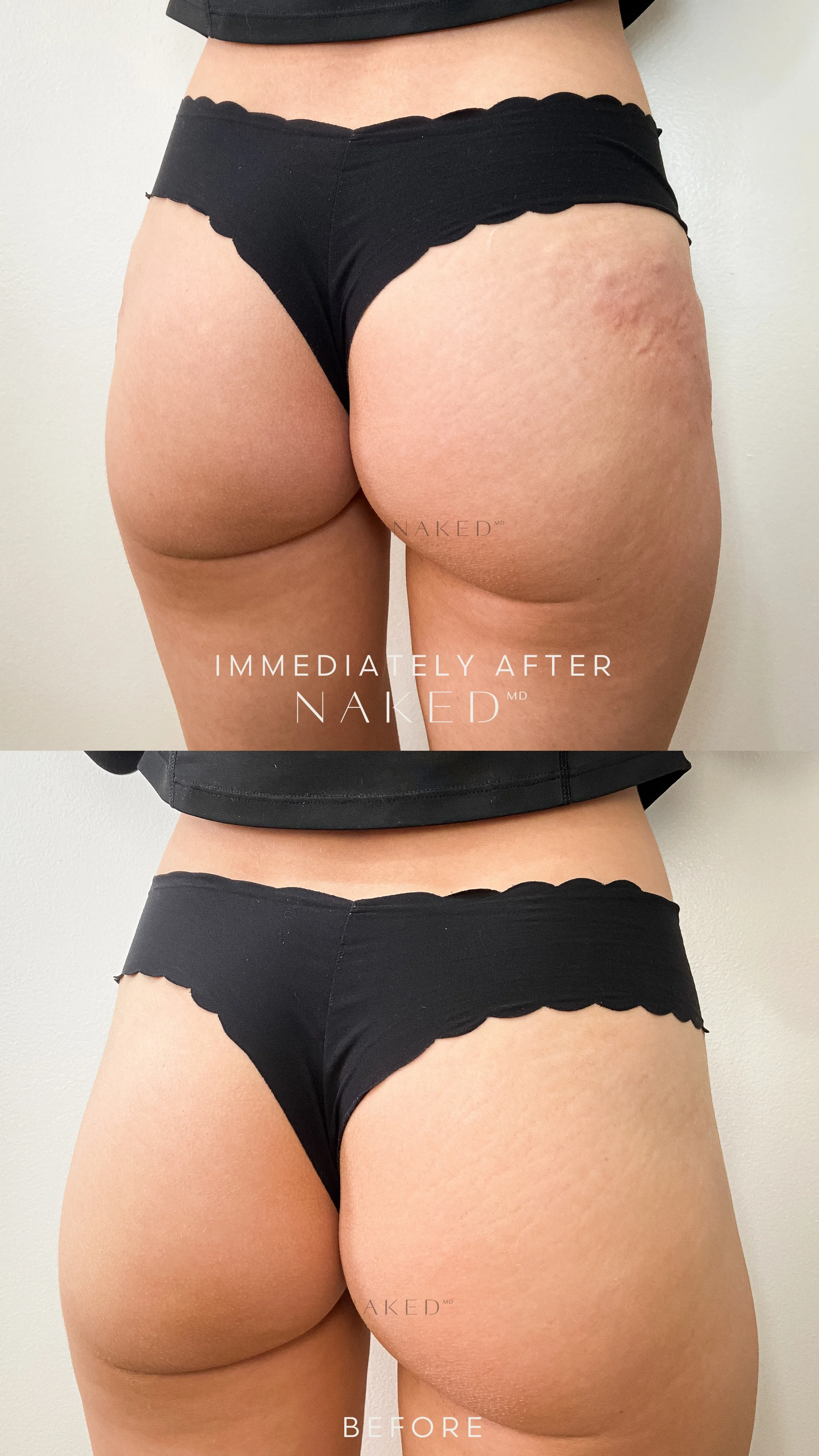 Naked Booty | Non-Surgical Brazilian Butt Lift (BBL) - Image 10