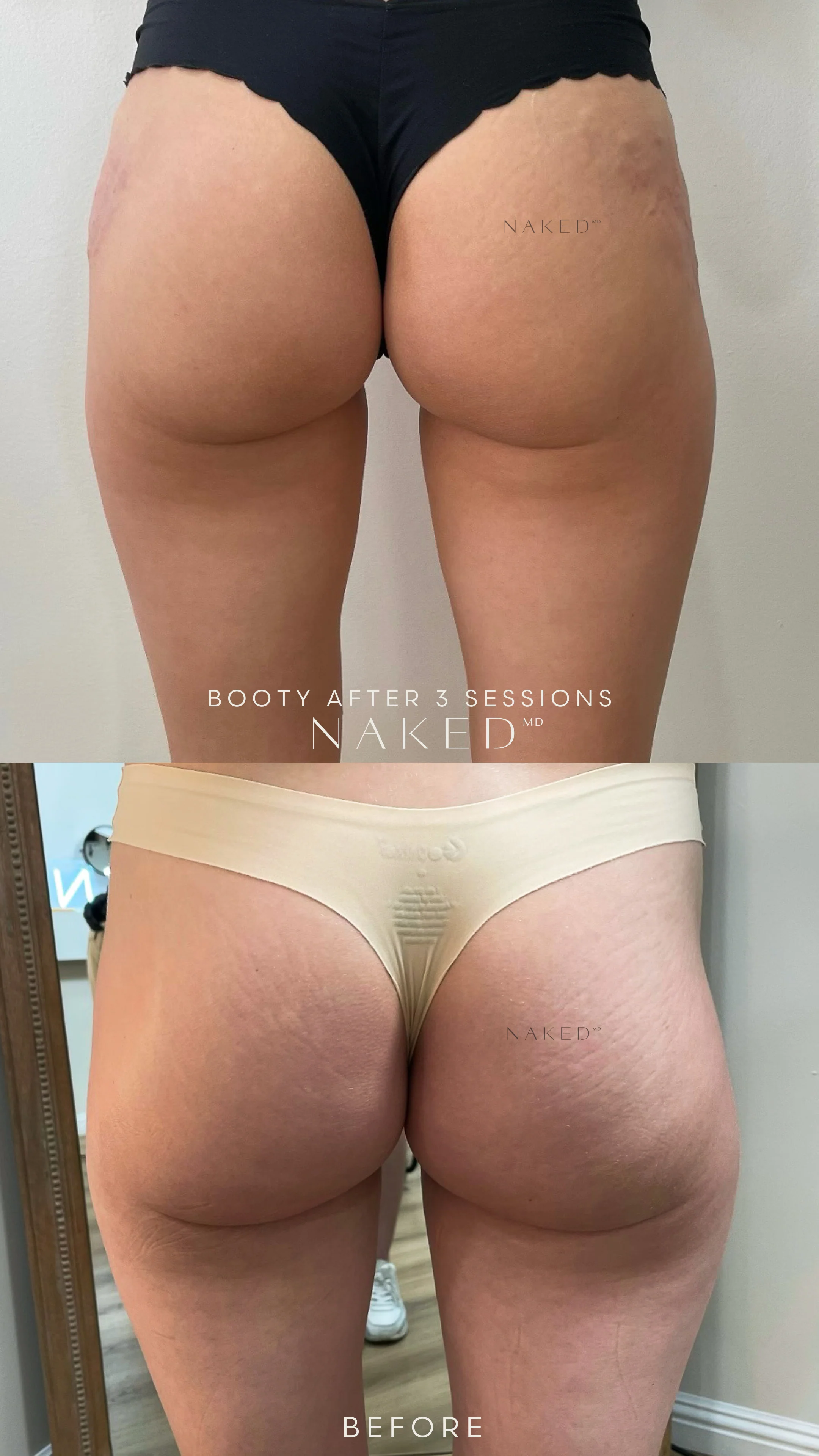 Naked Booty | Non-Surgical Brazilian Butt Lift (BBL) - Image 11