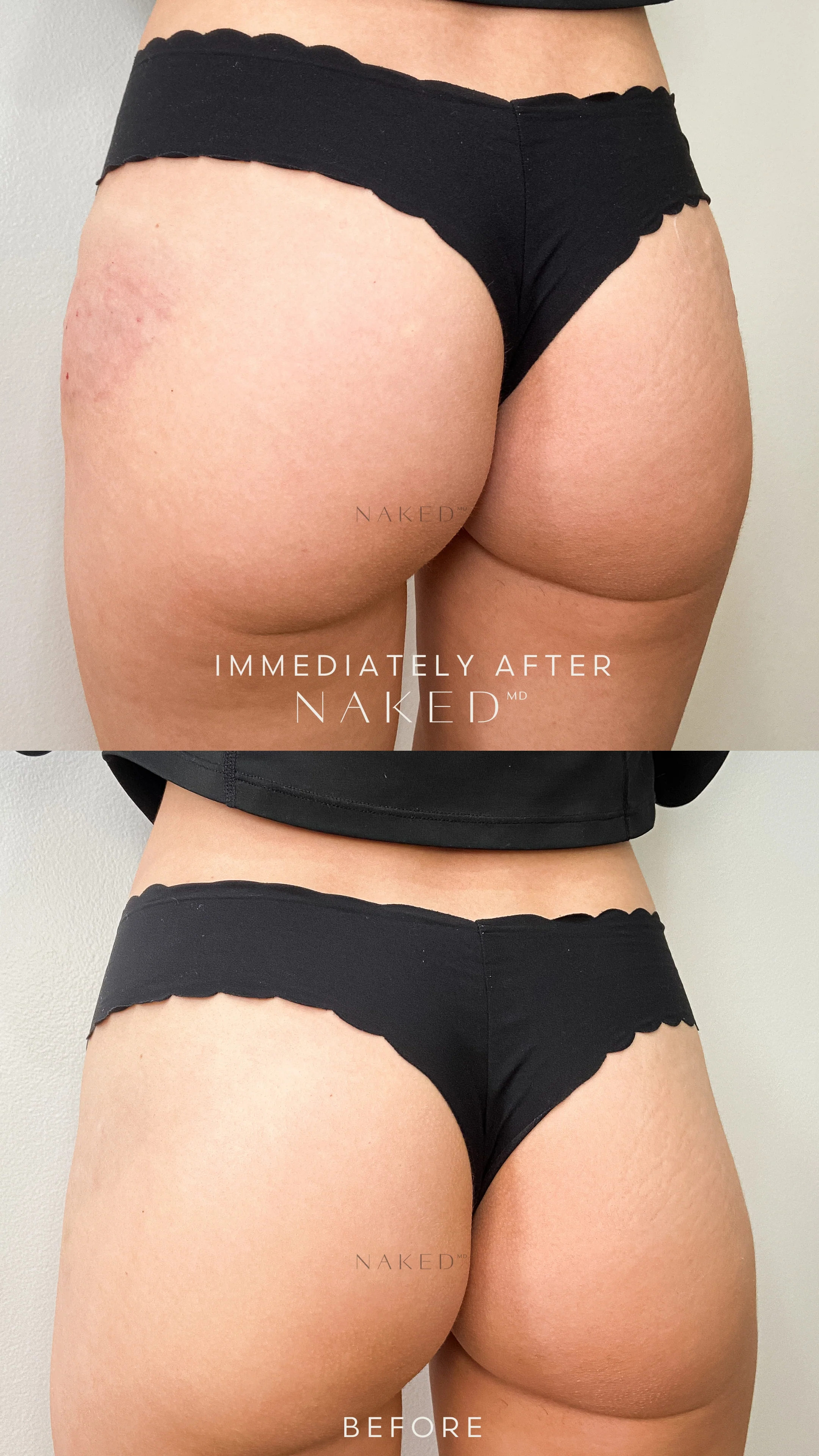 Naked Booty | Non-Surgical Brazilian Butt Lift (BBL) - Image 12