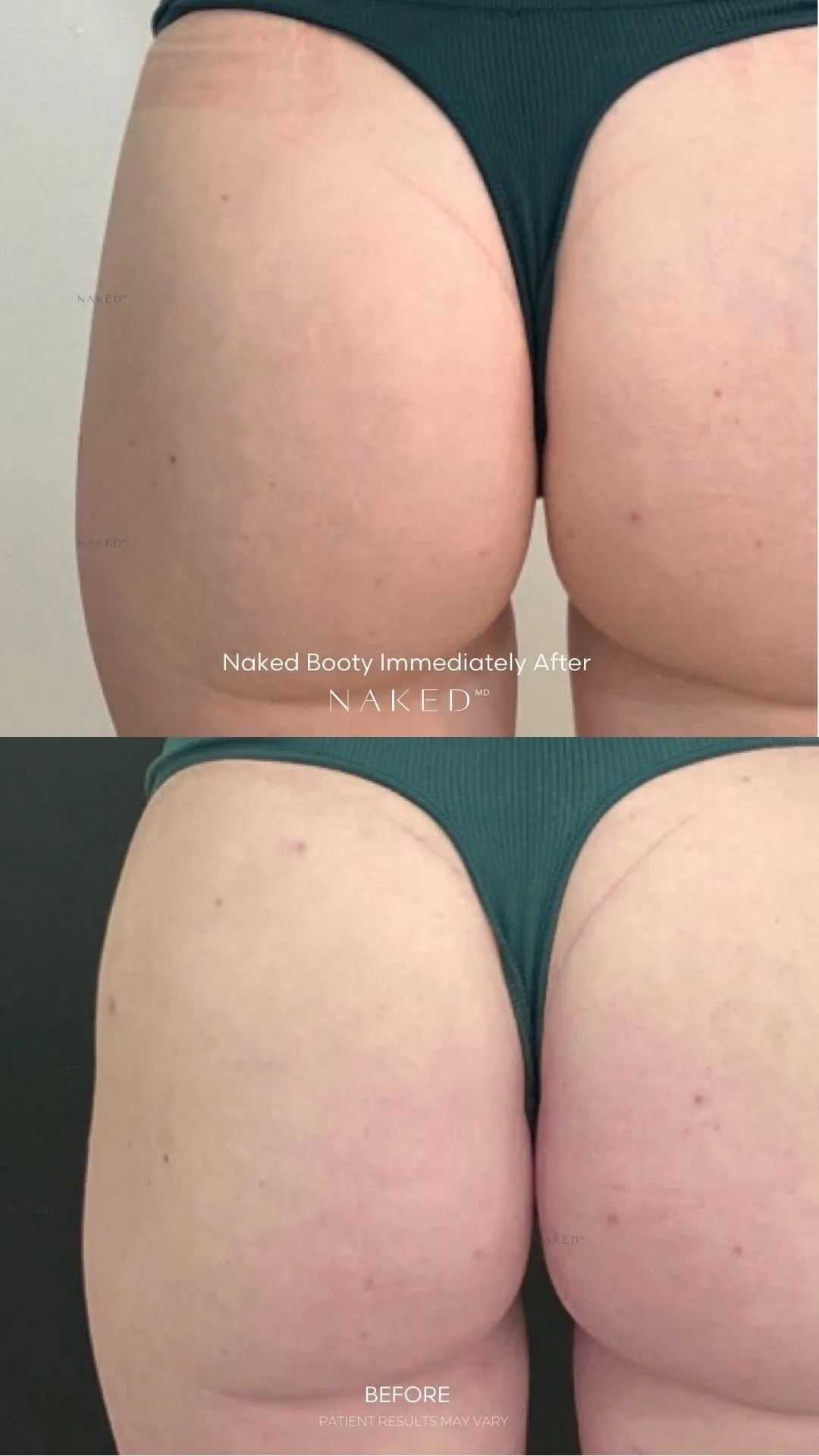 Naked Booty | Non-Surgical Brazilian Butt Lift (BBL) - Image 13