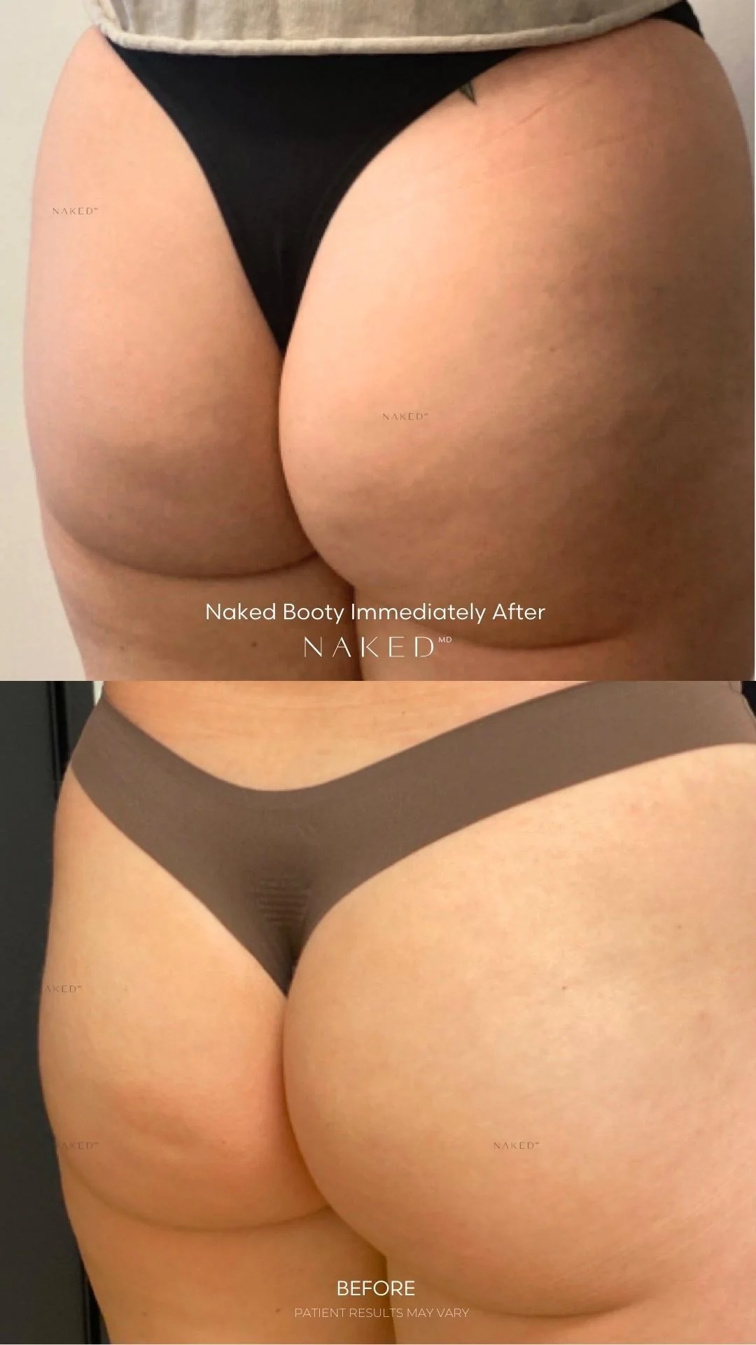 Naked Booty | Non-Surgical Brazilian Butt Lift (BBL) - Image 14