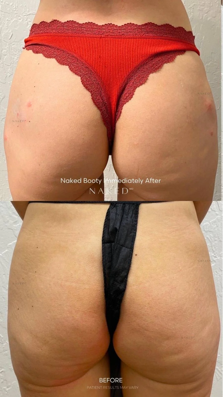 Naked Booty | Non-Surgical Brazilian Butt Lift (BBL) - Image 15