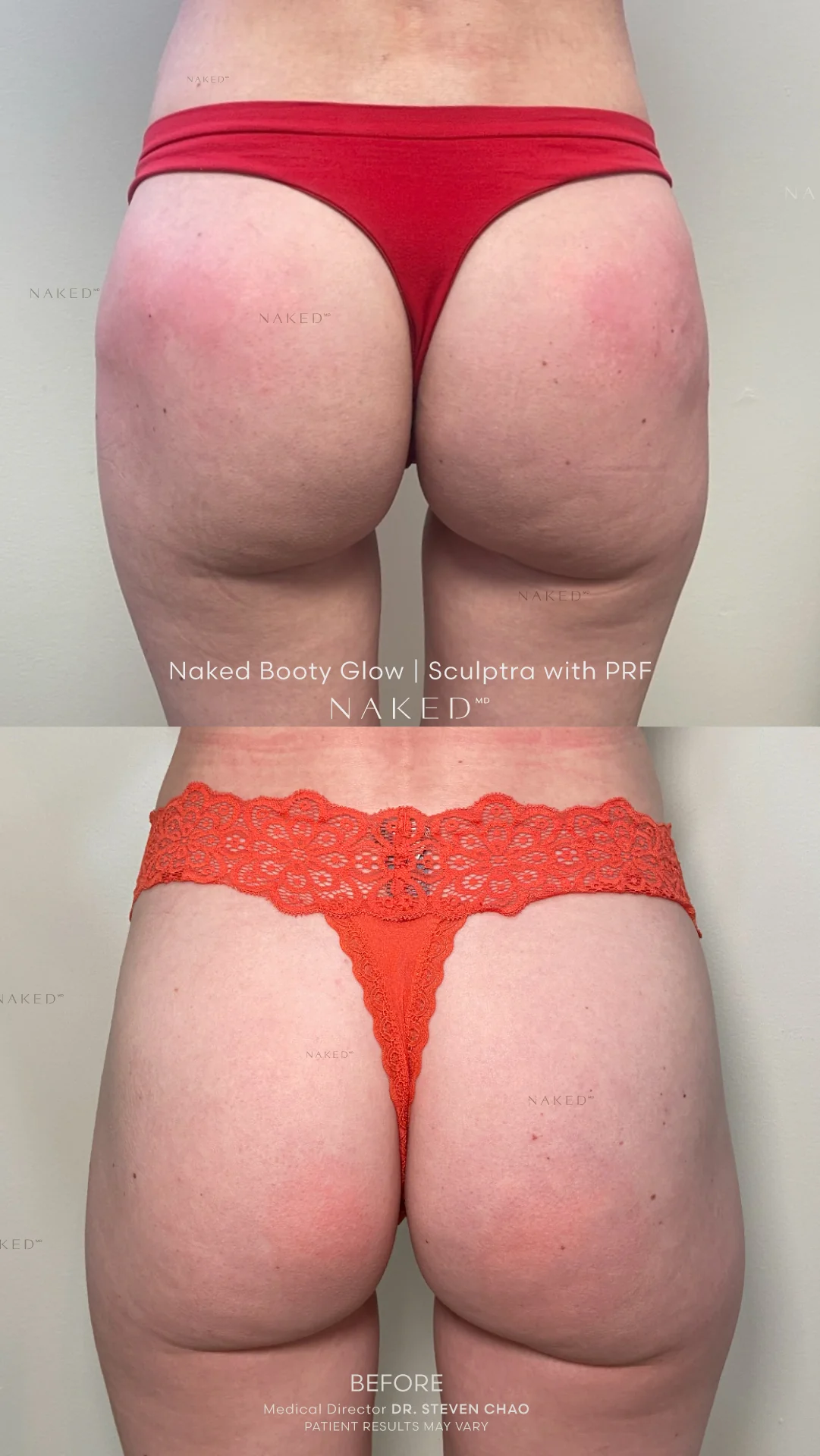 Naked Booty | Non-Surgical Brazilian Butt Lift (BBL) - Image 7