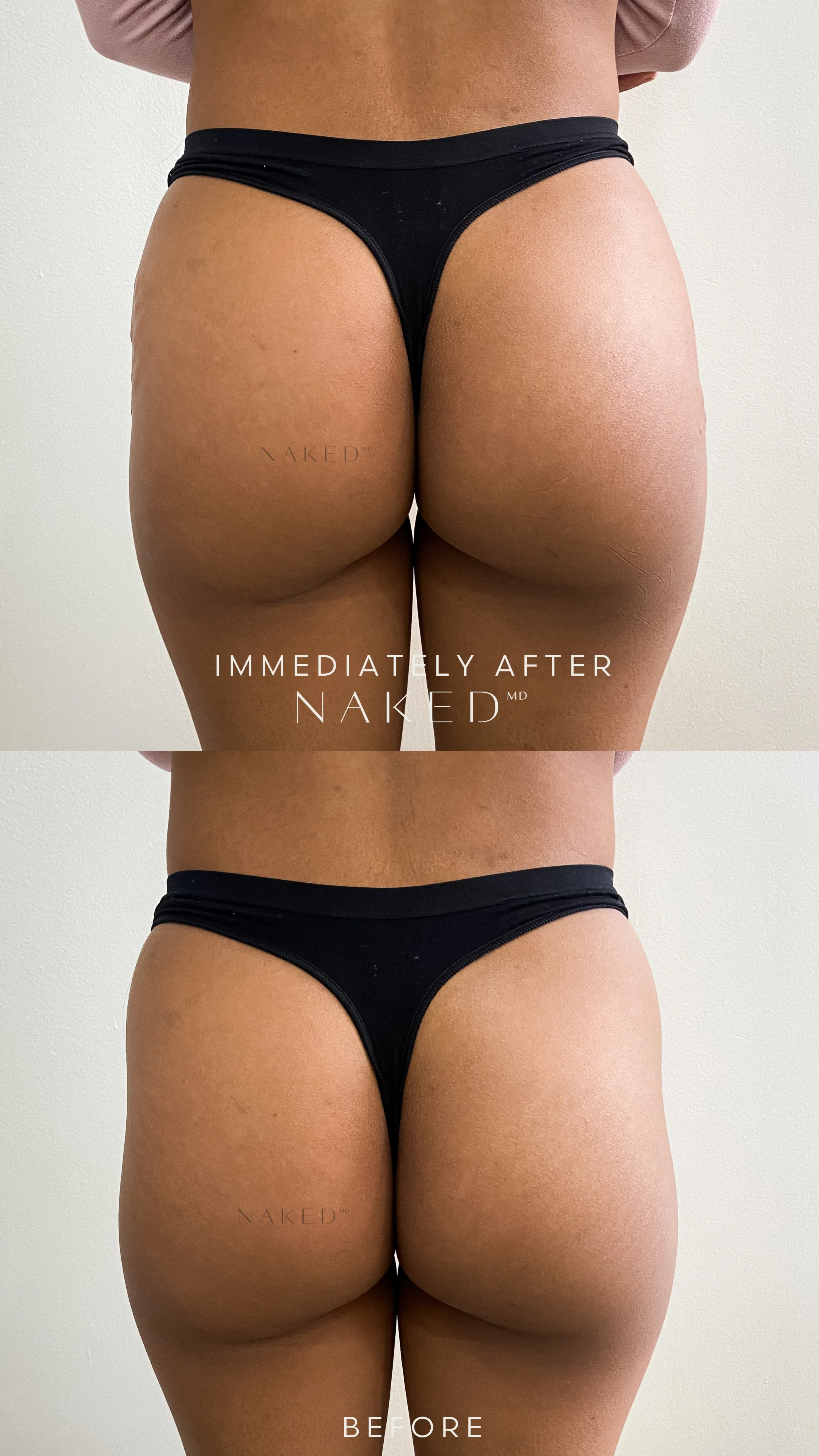Naked Booty | Non-Surgical Brazilian Butt Lift (BBL) - Image 8