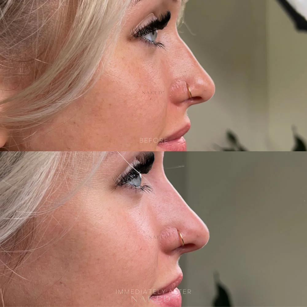 Naked Nose | Non-Surgical Nose Job (NSNJ) - Image 10