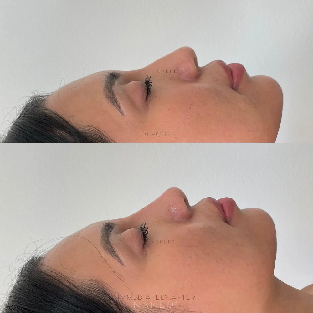 Naked Nose | Non-Surgical Nose Job (NSNJ) - Image 11