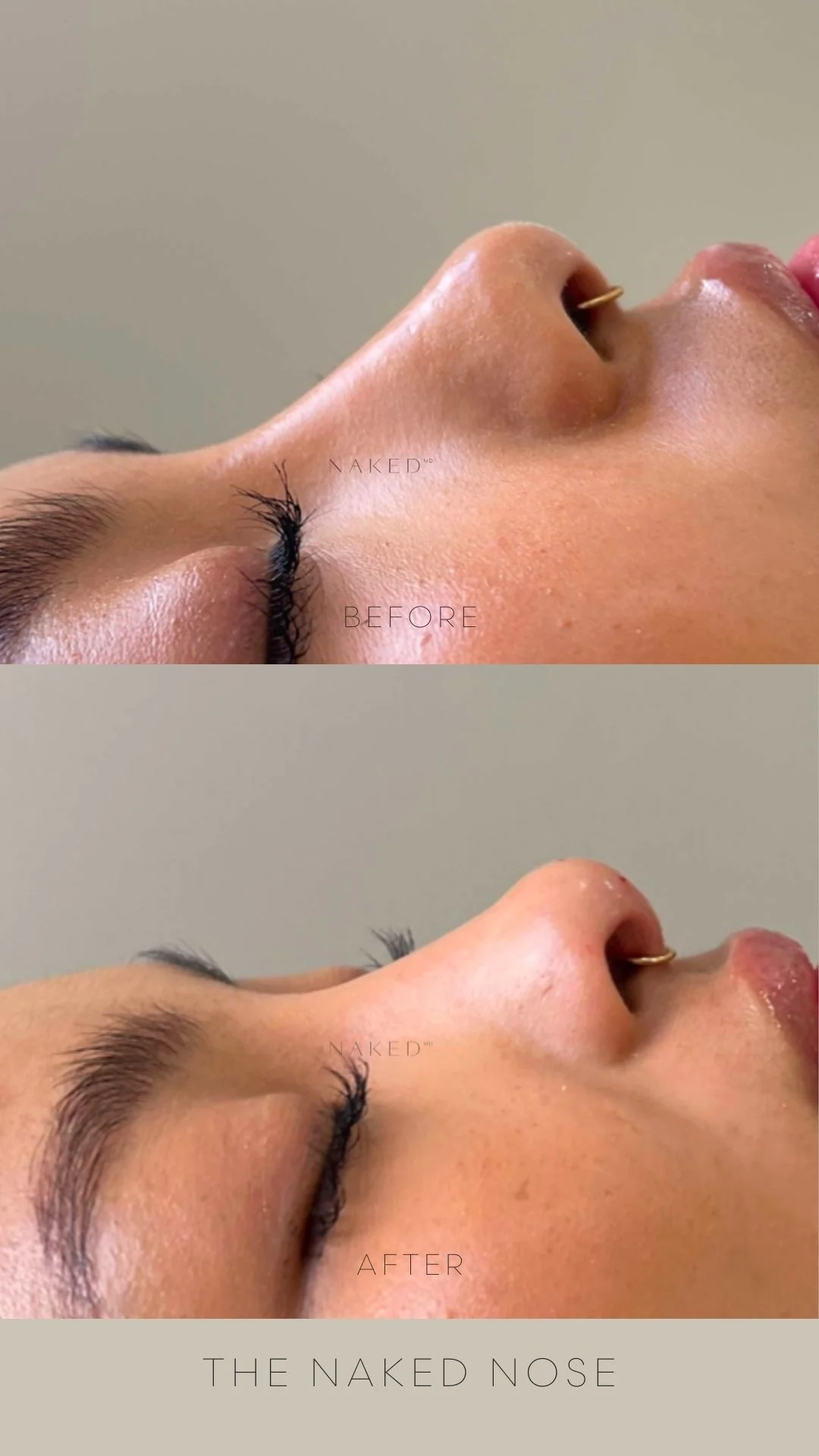 Naked Nose | Non-Surgical Nose Job (NSNJ) - Image 13