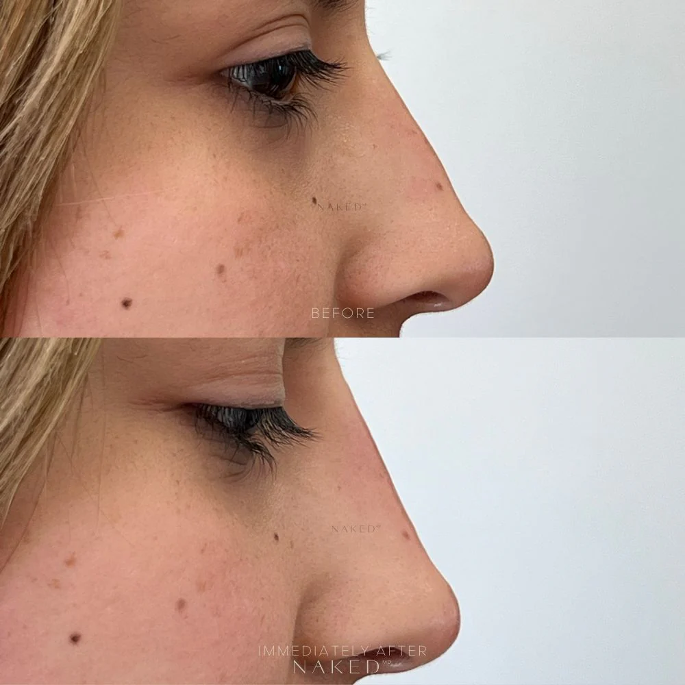 Naked Nose | Non-Surgical Nose Job (NSNJ) - Image 14