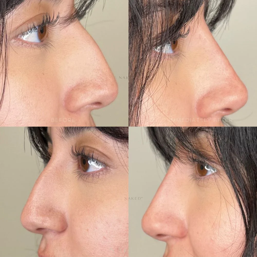 Naked Nose | Non-Surgical Nose Job (NSNJ) - Image 15