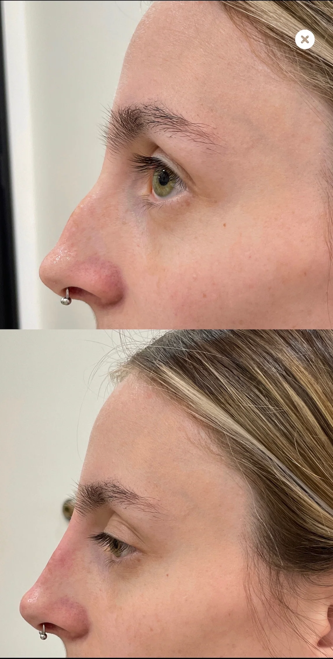 Naked Nose | Non-Surgical Nose Job (NSNJ) - Image 16