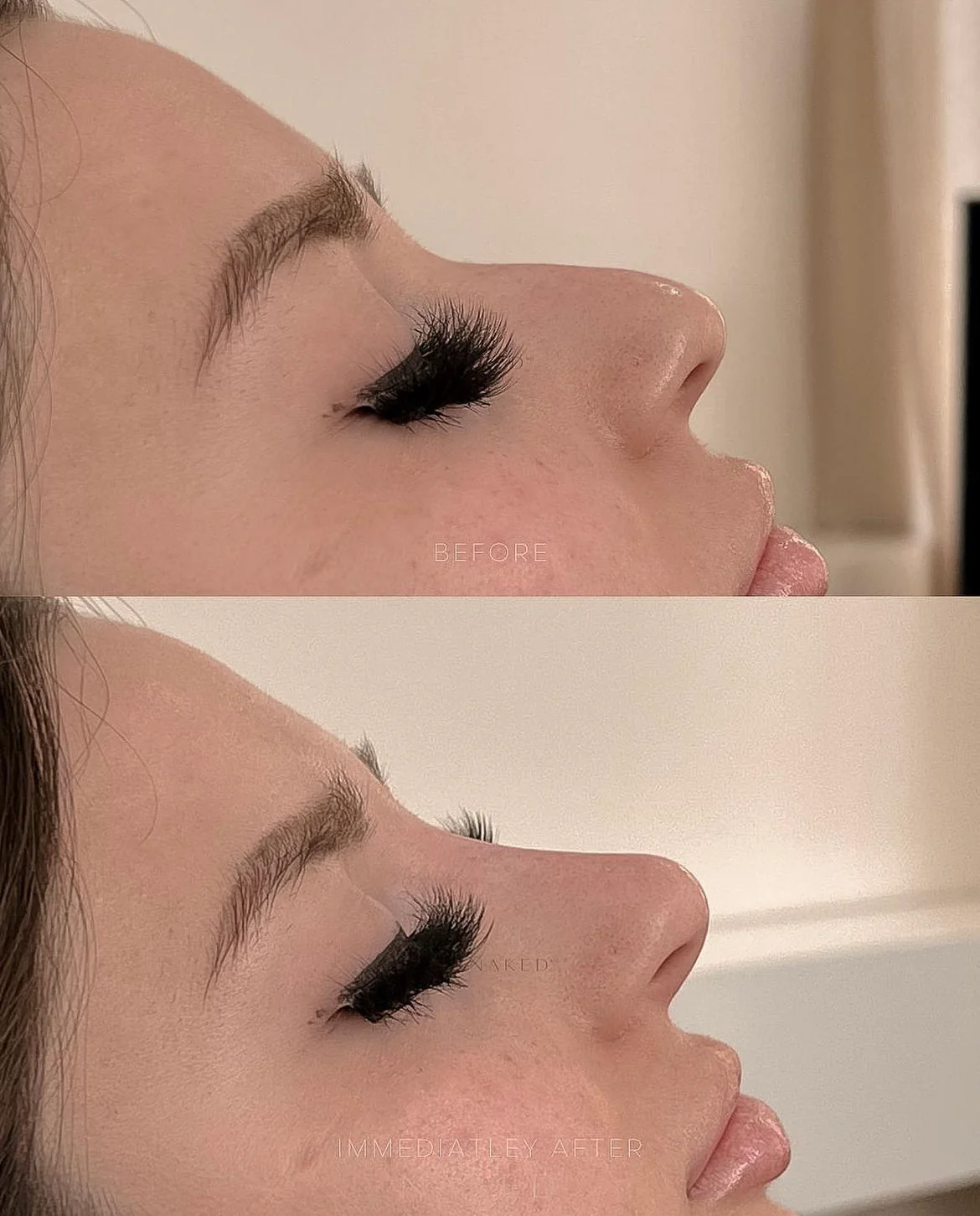 Naked Nose | Non-Surgical Nose Job (NSNJ) - Image 17