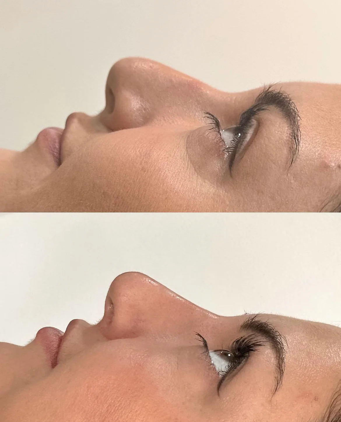 Naked Nose | Non-Surgical Nose Job (NSNJ) - Image 18