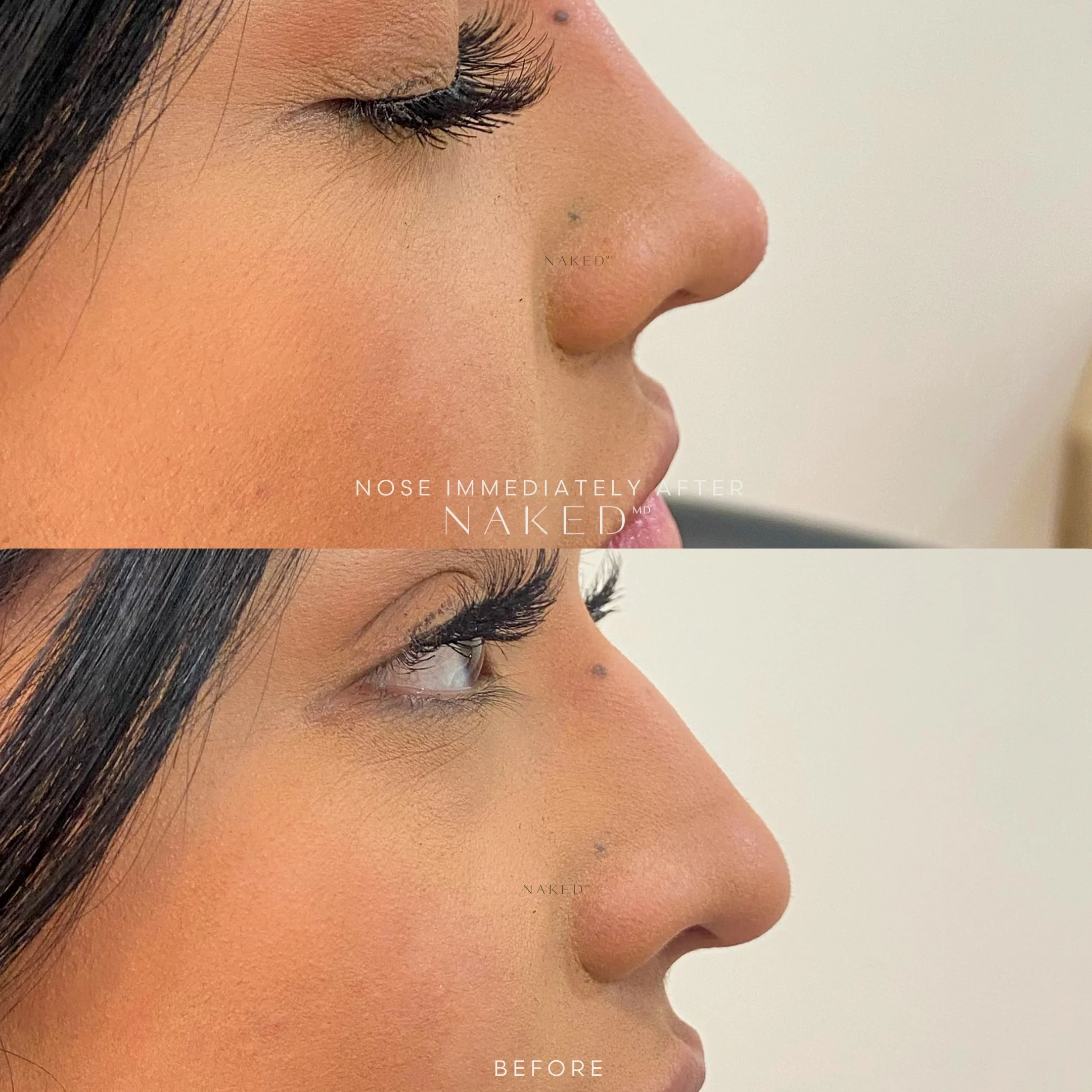 Naked Nose | Non-Surgical Nose Job (NSNJ) - Image 19