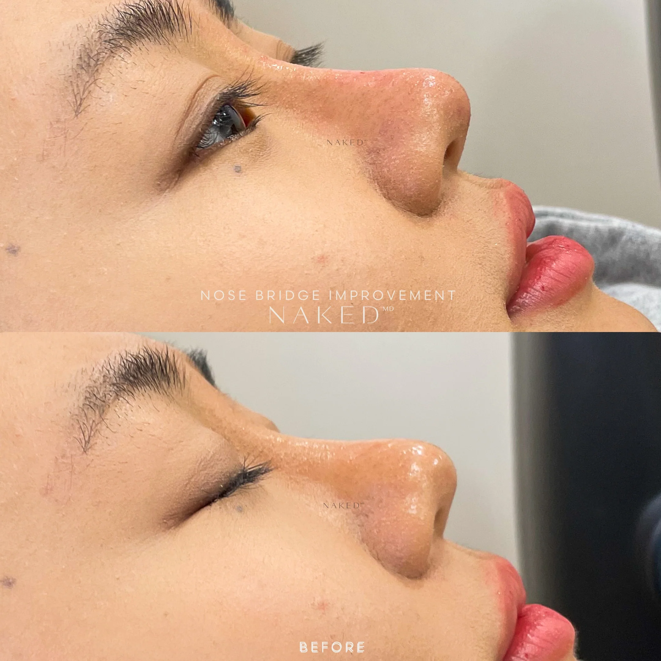 Naked Nose | Non-Surgical Nose Job (NSNJ) - Image 20