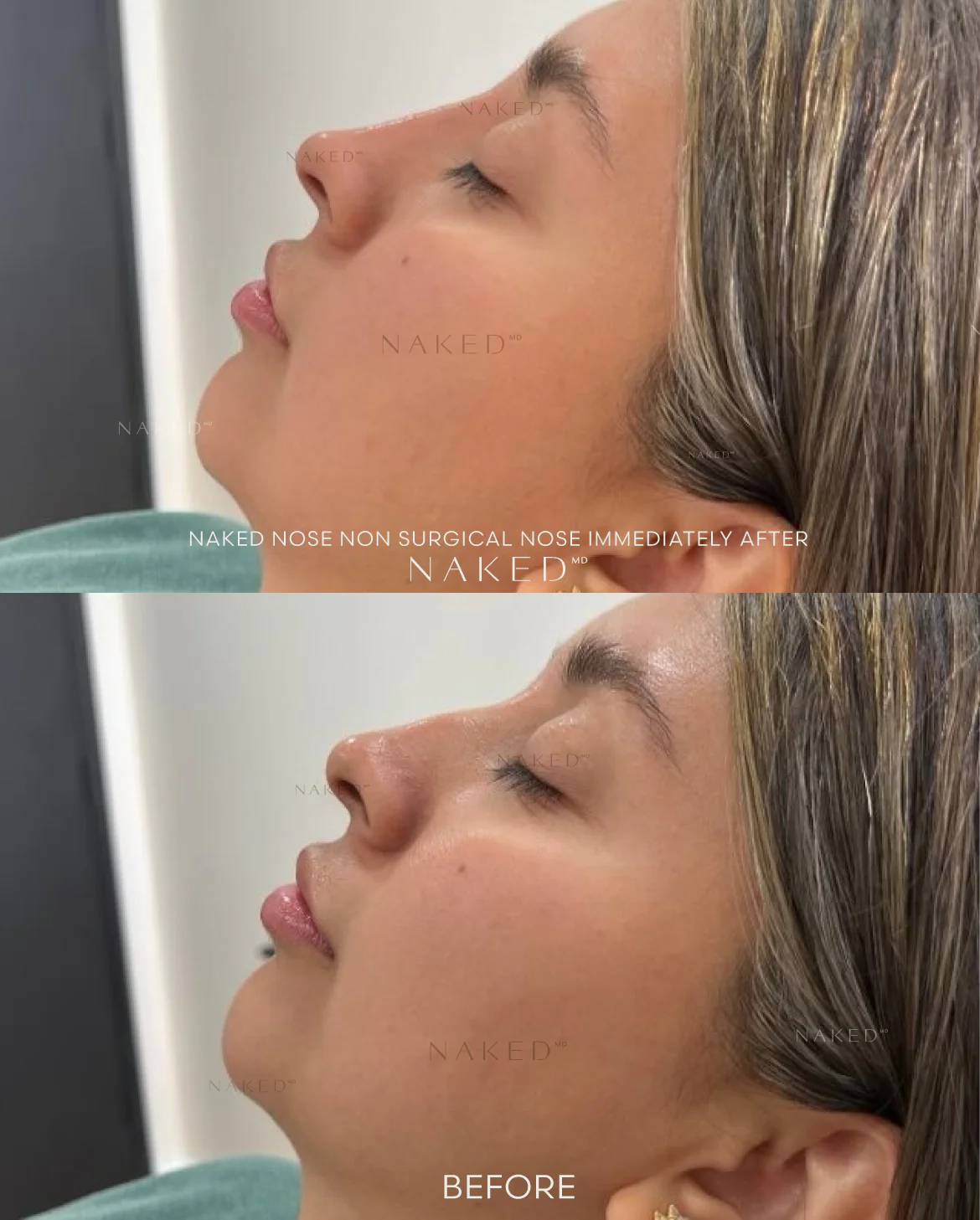Naked Nose | Non-Surgical Nose Job (NSNJ) - Image 21
