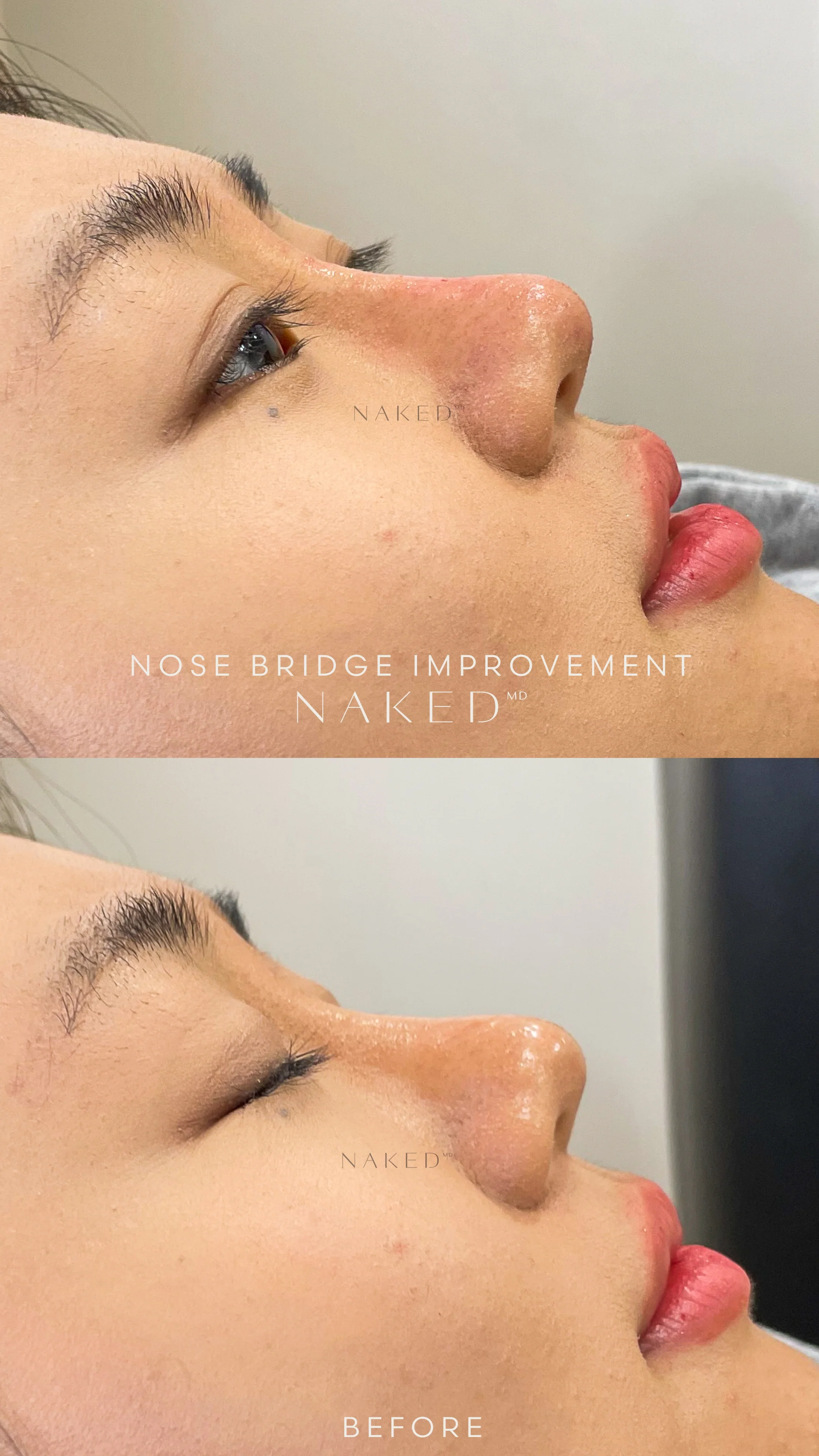 Naked Nose | Non-Surgical Nose Job (NSNJ) - Image 23