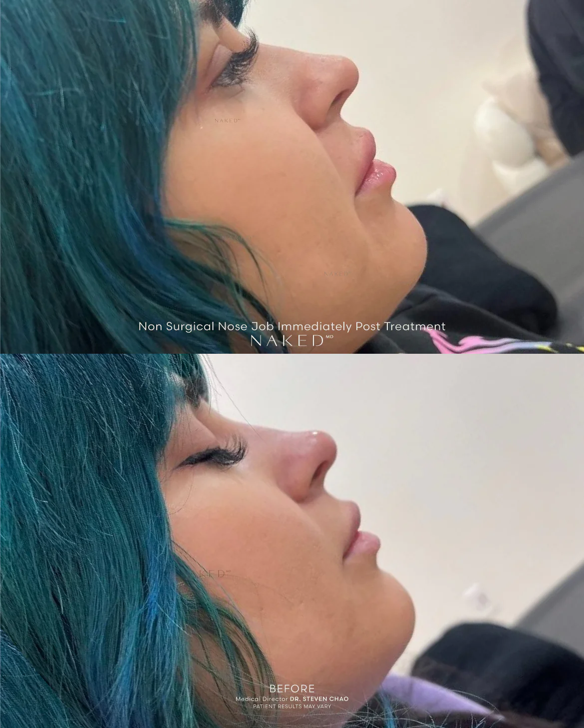 Naked Nose | Non-Surgical Nose Job (NSNJ) - Image 24