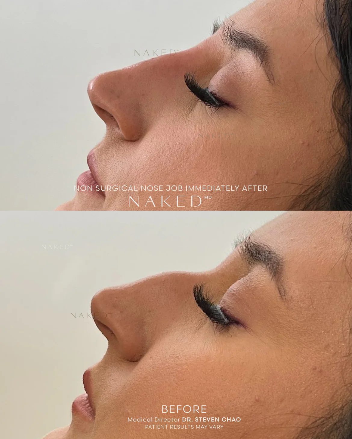 Naked Nose | Non-Surgical Nose Job (NSNJ) - Image 25