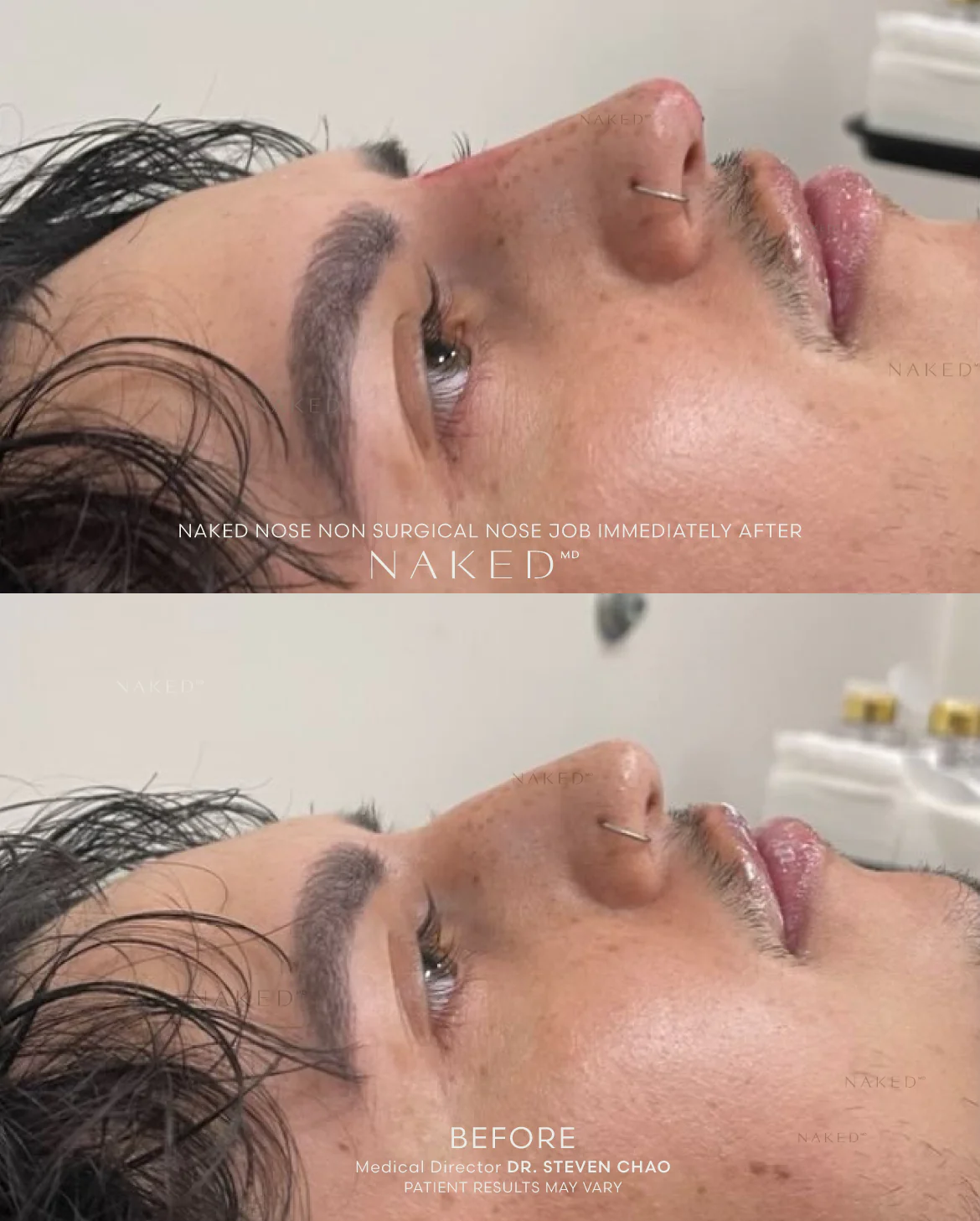 Naked Nose | Non-Surgical Nose Job (NSNJ) - Image 26