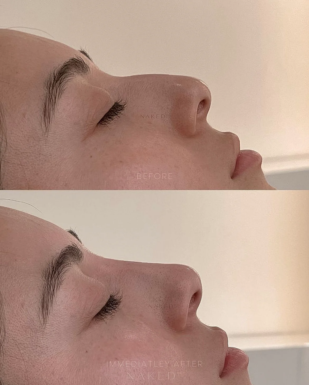Naked Nose | Non-Surgical Nose Job (NSNJ) - Image 8