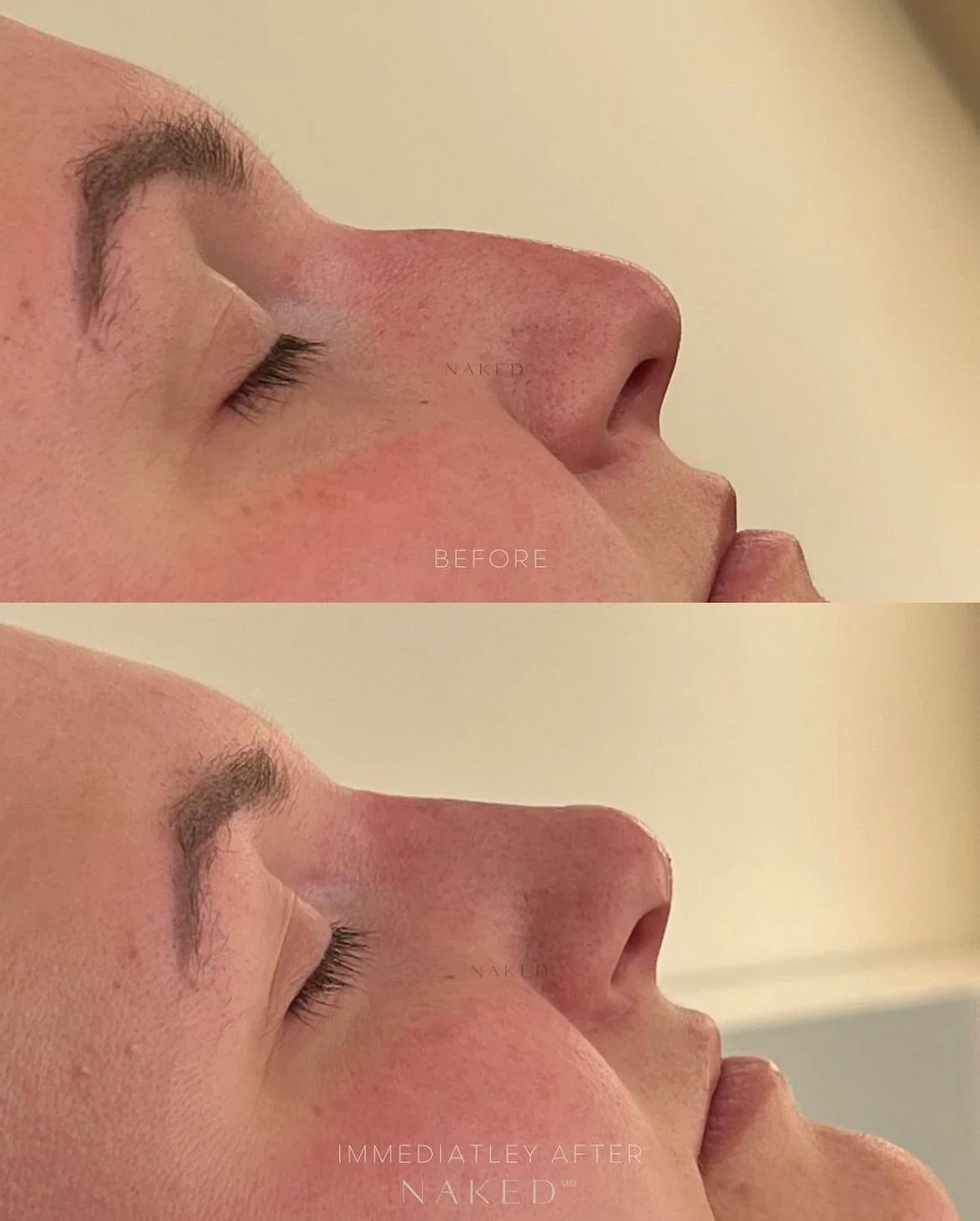 Naked Nose | Non-Surgical Nose Job (NSNJ) - Image 9