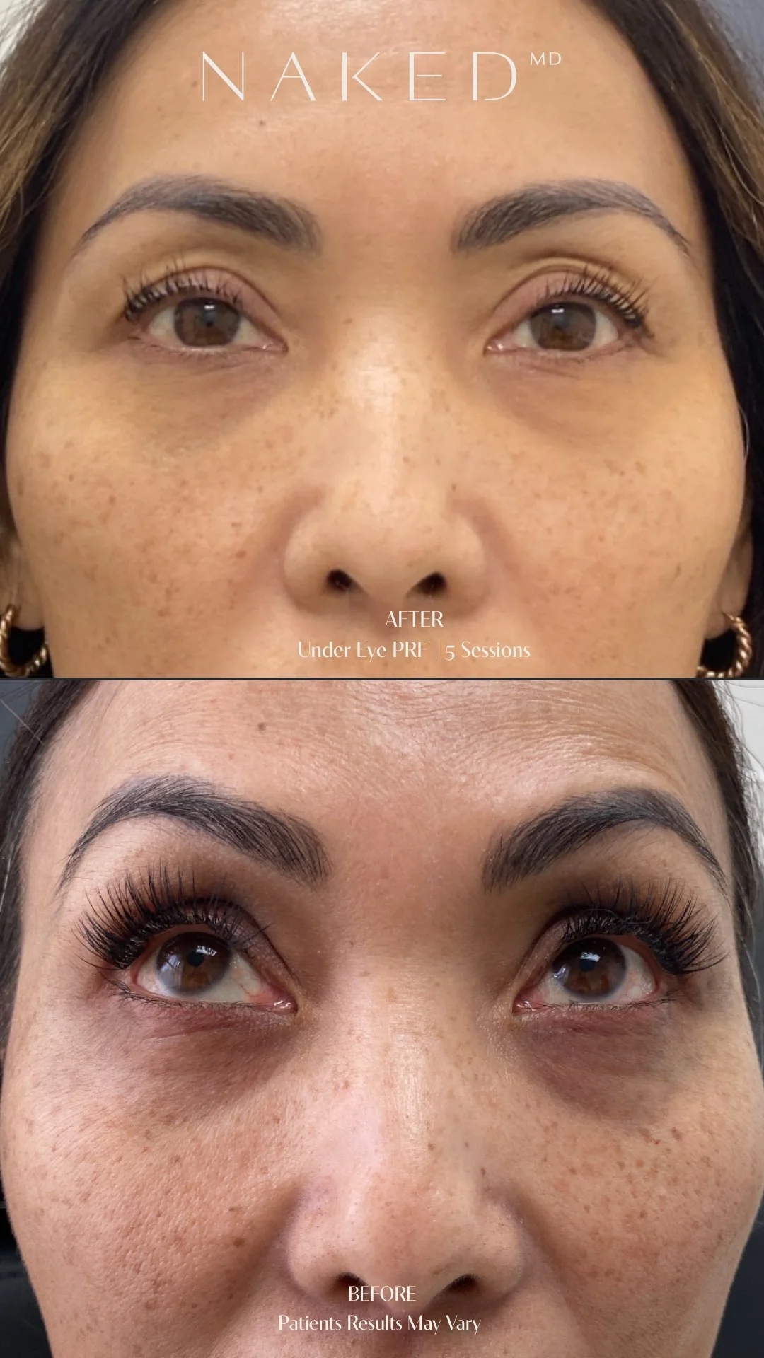 PRF (Platelet Rich Fibrin) Injection - Image 3