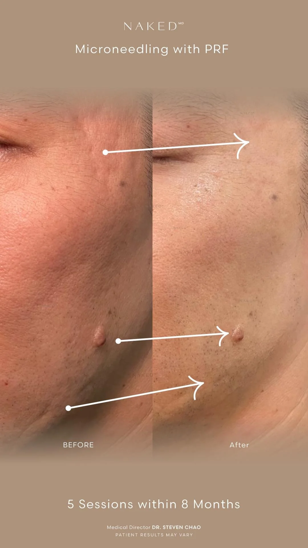 PRF (Platelet Rich Fibrin) Injection - Image 5