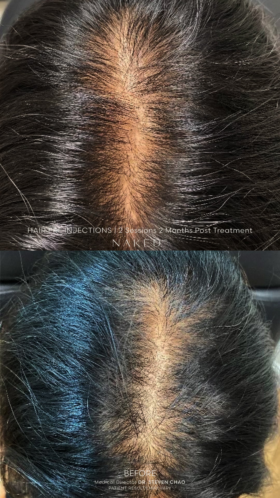 PRF (Platelet Rich Fibrin) Injection - Image 6