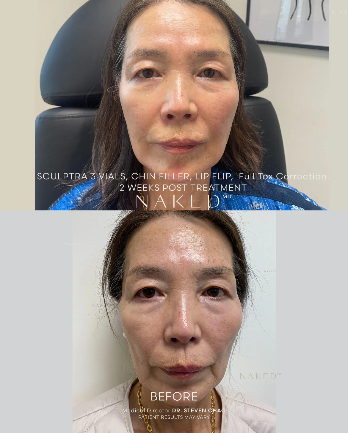 Sculptra® Filler - Image 11