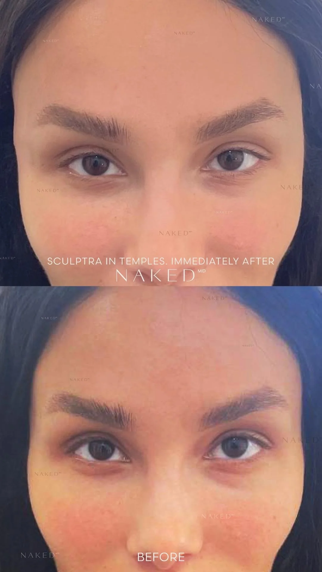 Sculptra® Filler - Image 6