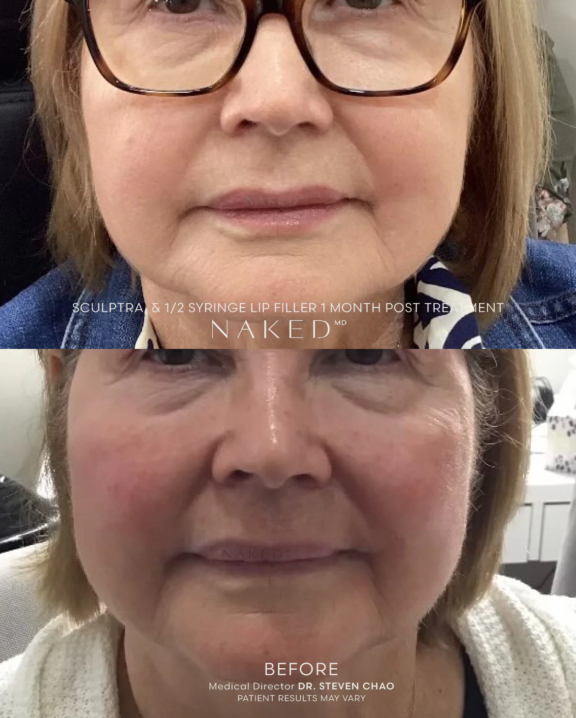 Sculptra® Filler - Image 7