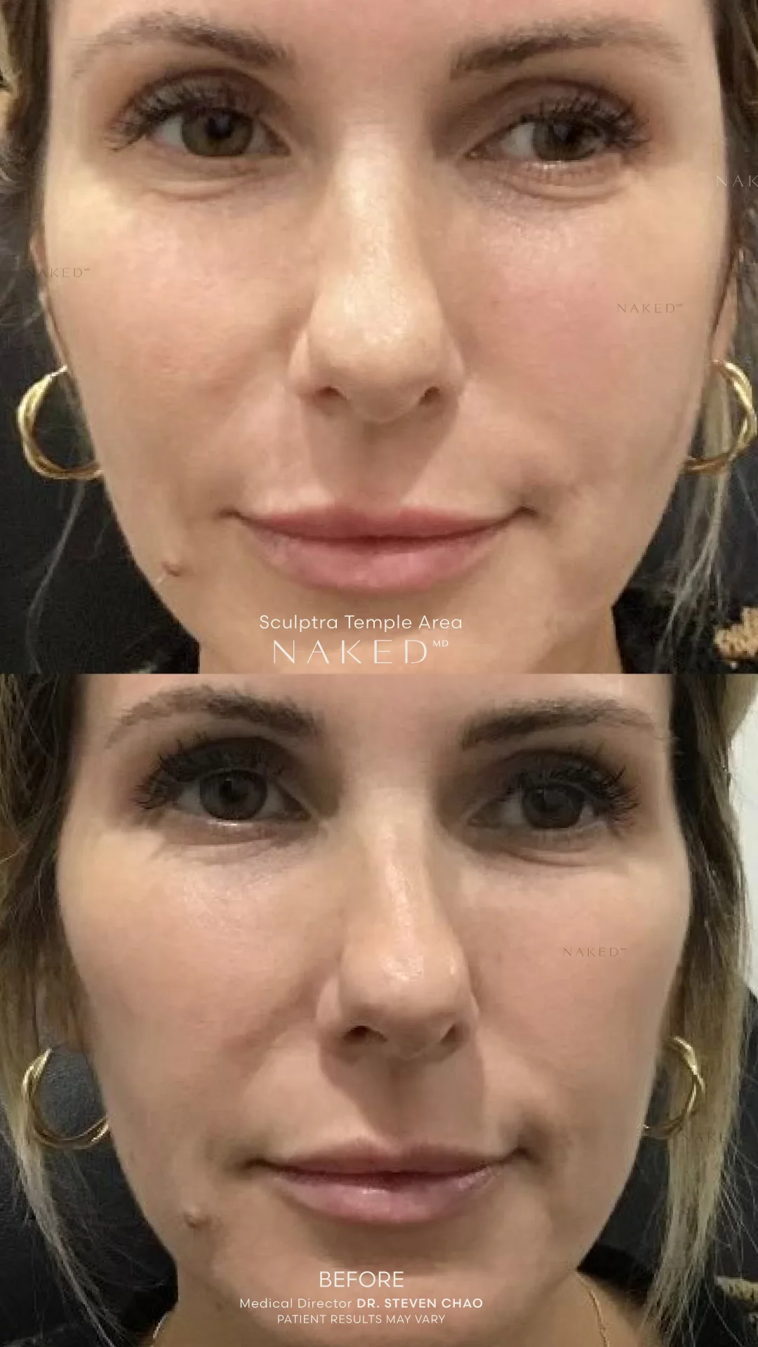 Sculptra® Filler - Image 8