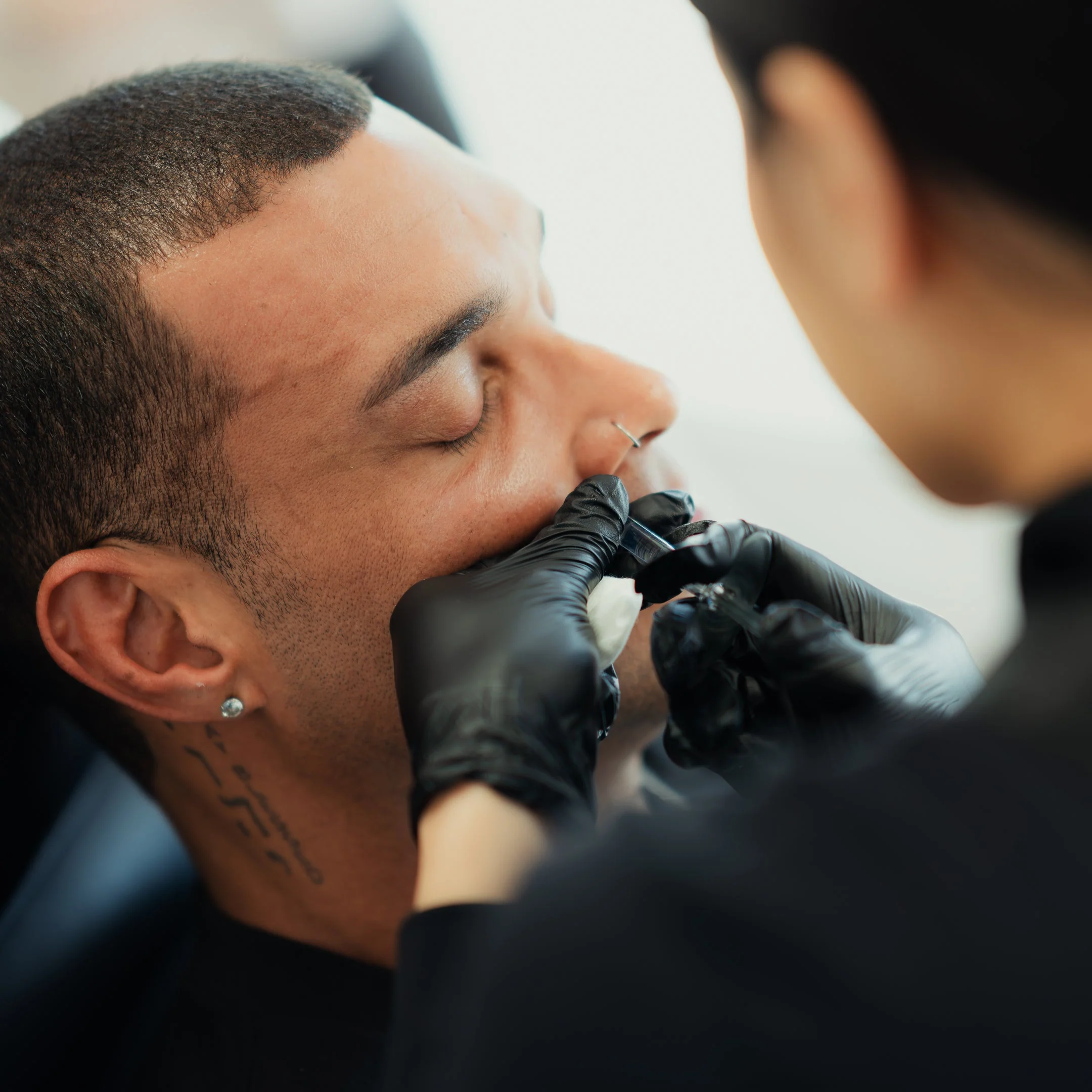 Smile Lines Filler - Image 3