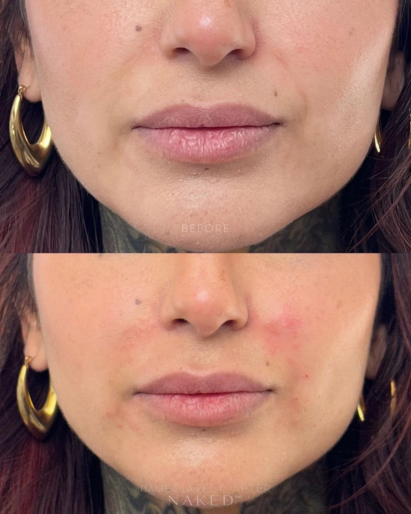 Smile Lines Filler - Image 6