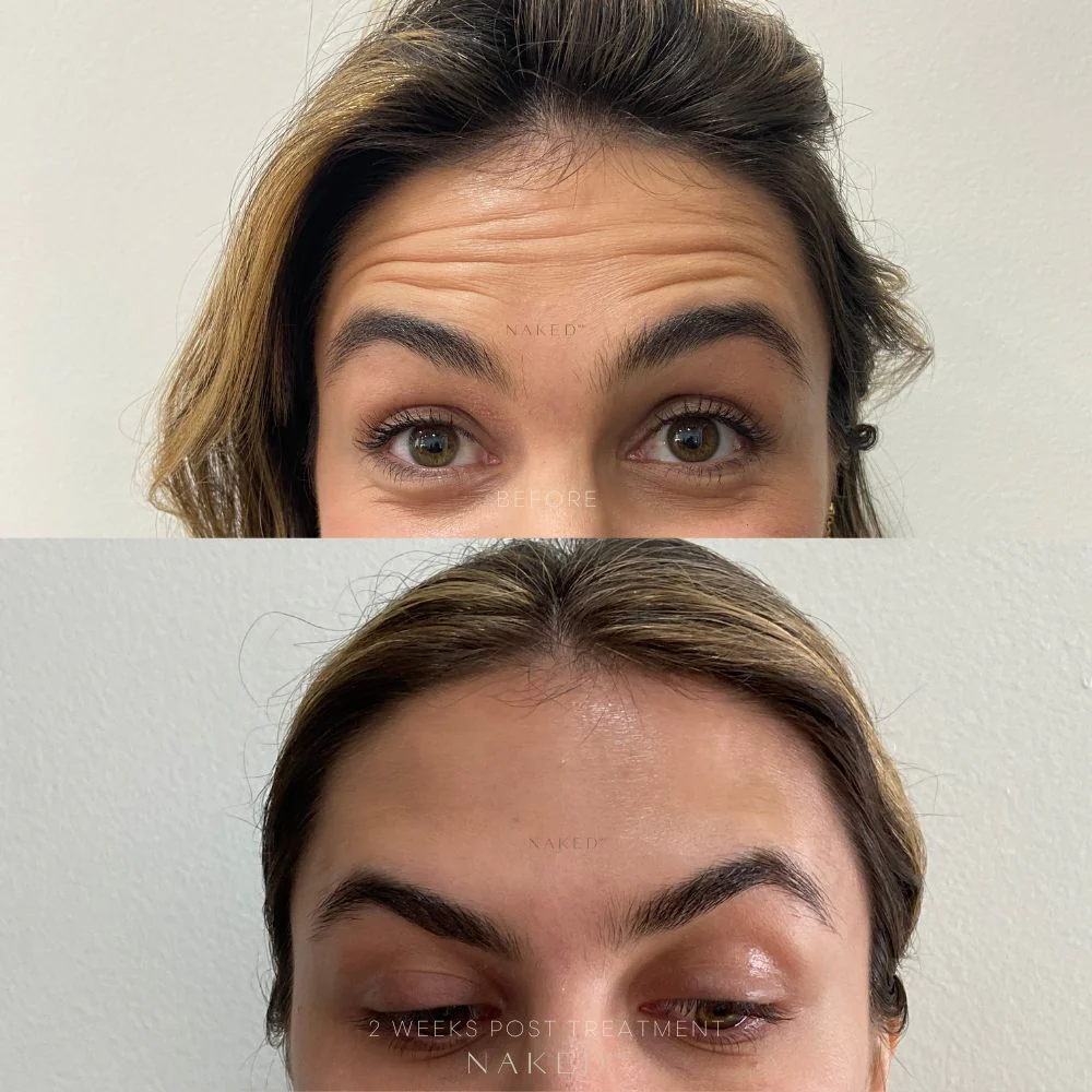 Naked TOX | Neurotoxins - Image 3