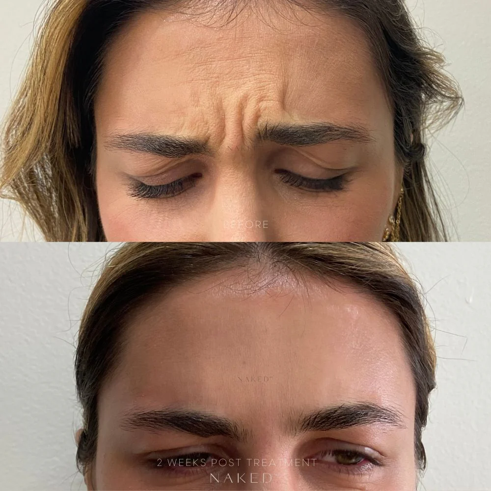 Naked TOX | Neurotoxins - Image 6