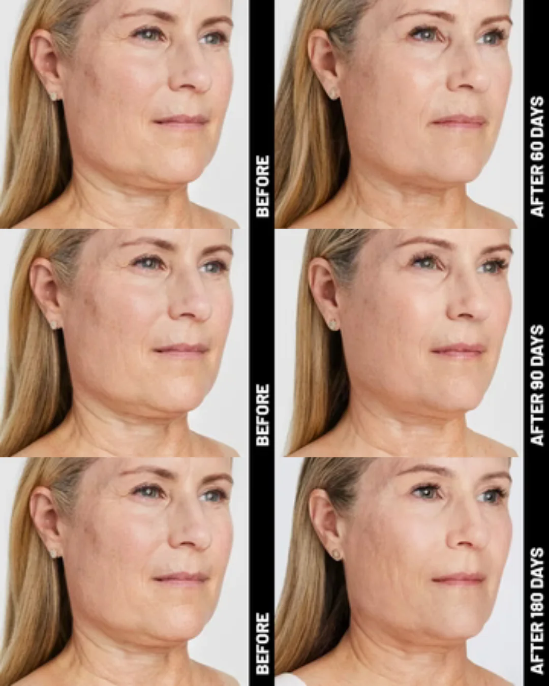 Ultherapy® | Non-Surgical Ultrasound Therapy - Image 10