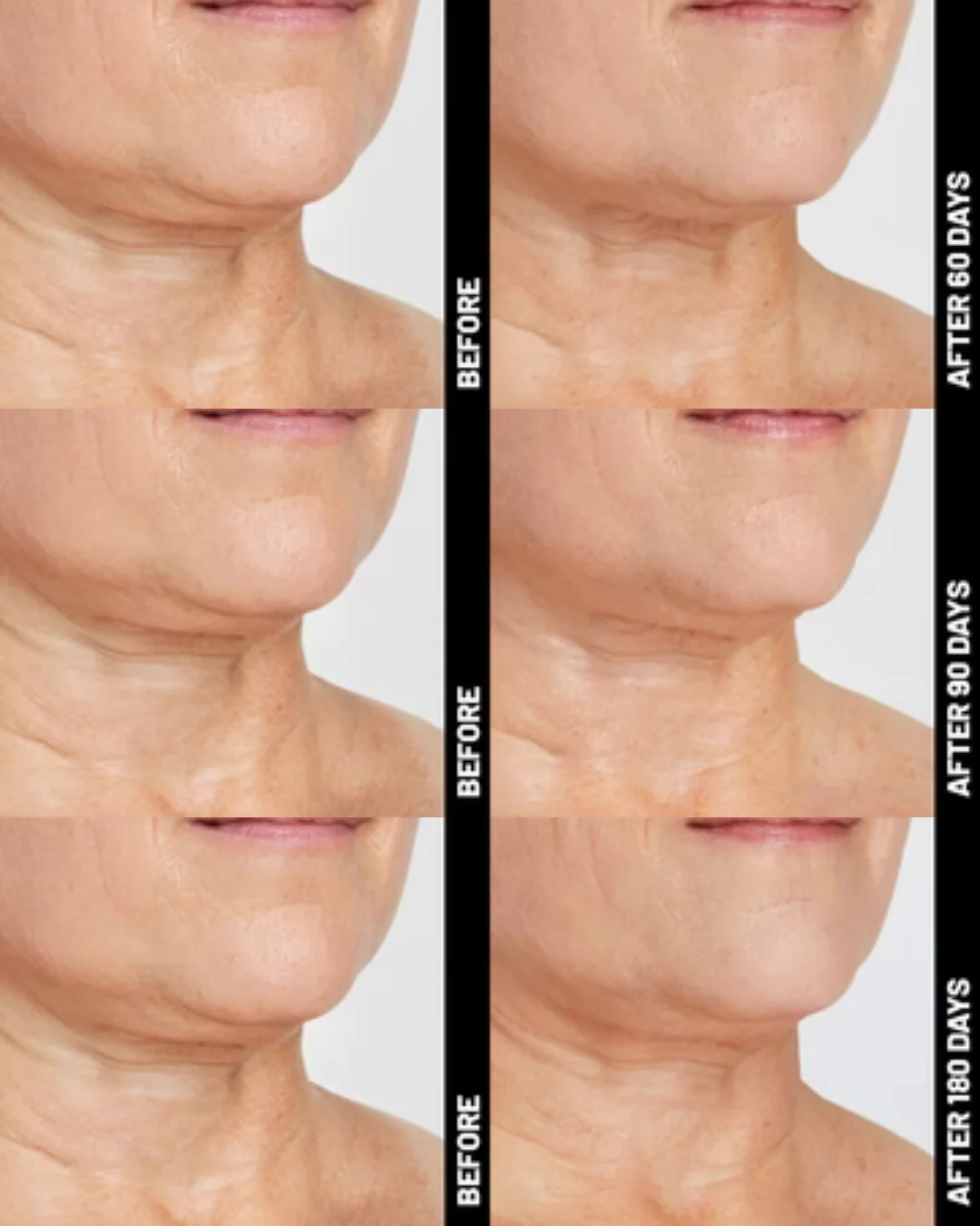 Ultherapy® | Non-Surgical Ultrasound Therapy - Image 11