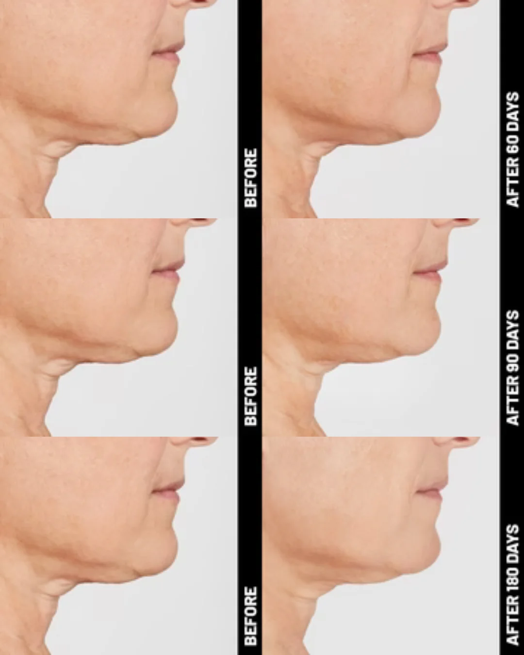 Ultherapy® | Non-Surgical Ultrasound Therapy - Image 12