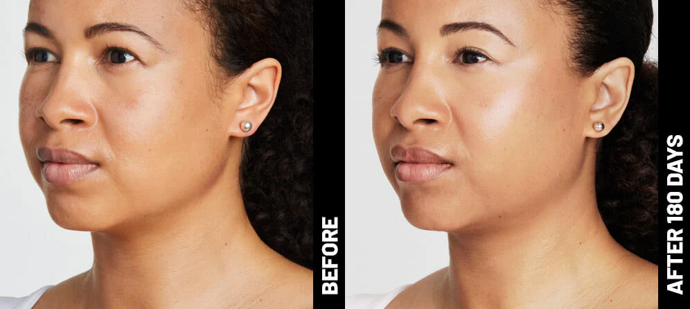 Ultherapy® | Non-Surgical Ultrasound Therapy - Image 15