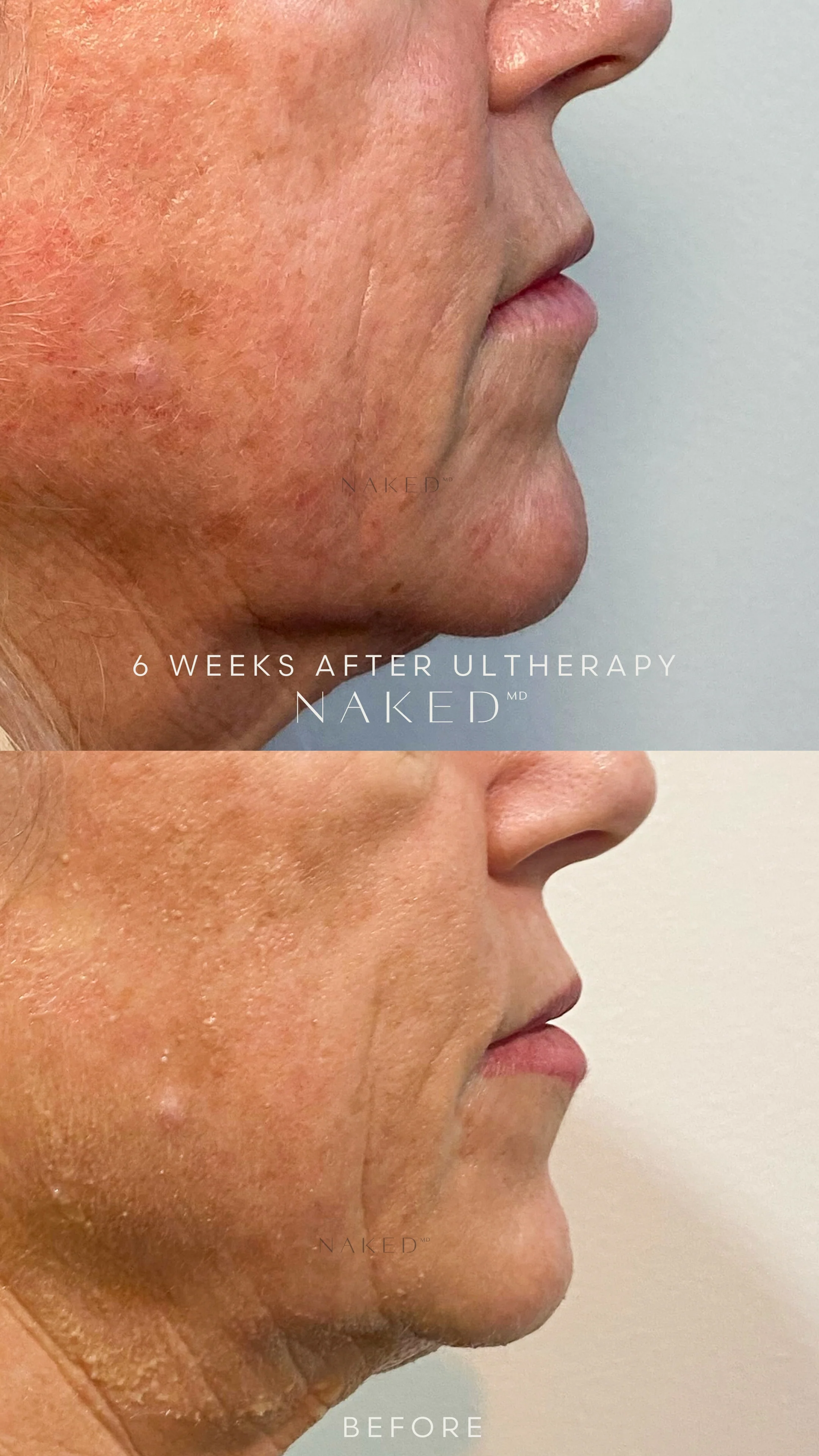 Ultherapy® | Non-Surgical Ultrasound Therapy - Image 4