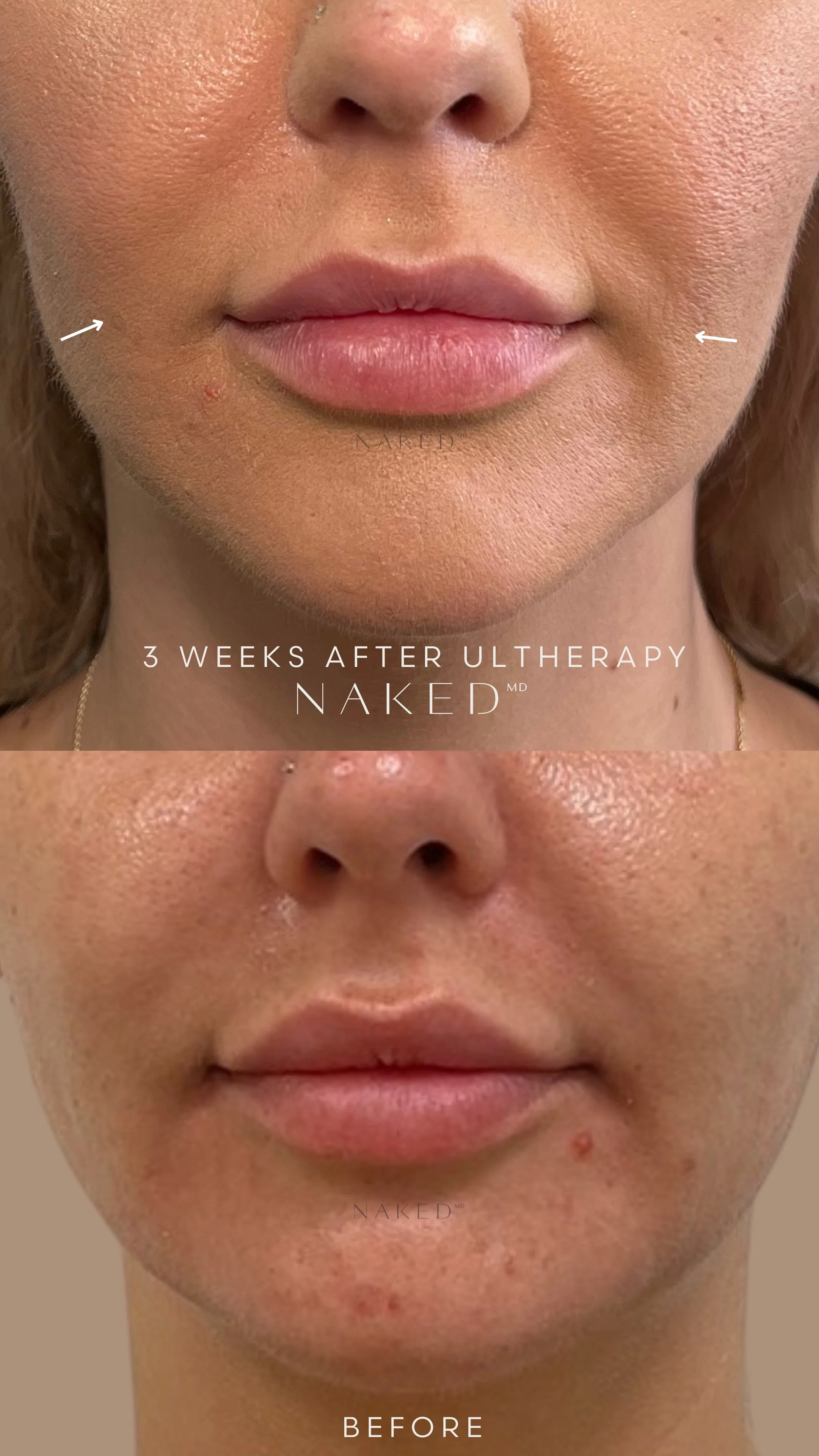 Ultherapy® | Non-Surgical Ultrasound Therapy - Image 6