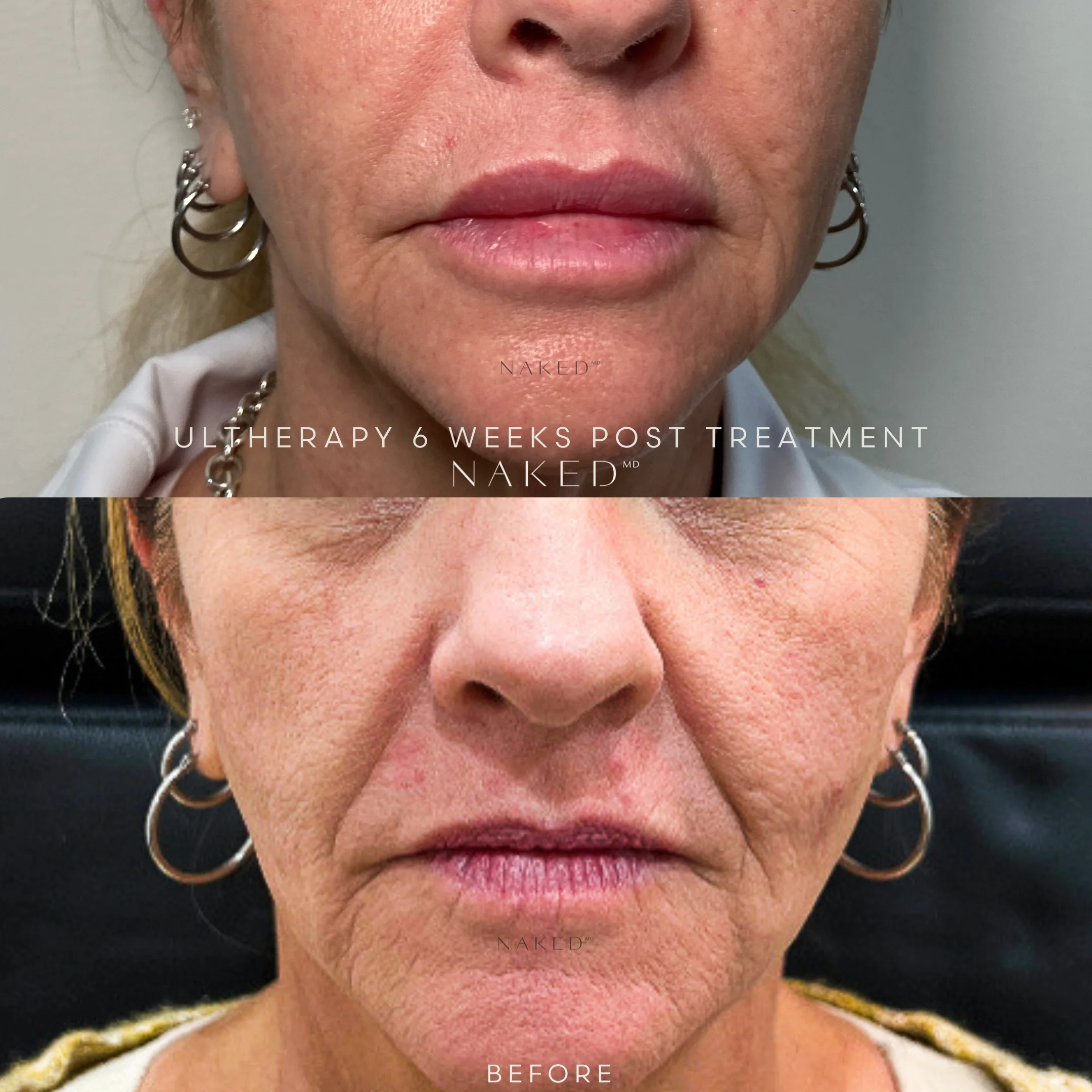 Ultherapy® | Non-Surgical Ultrasound Therapy - Image 8