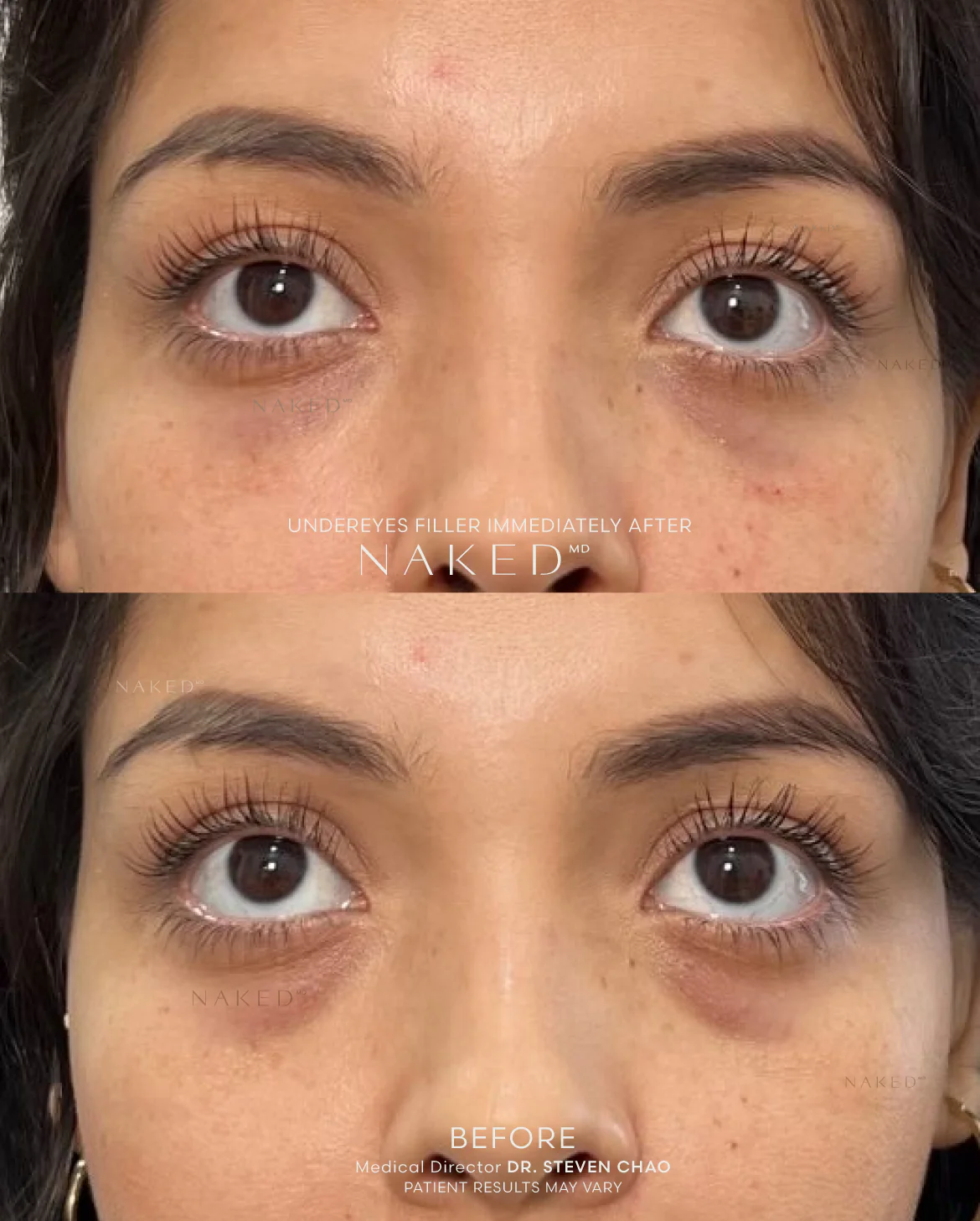 Undereye Filler - Image 4