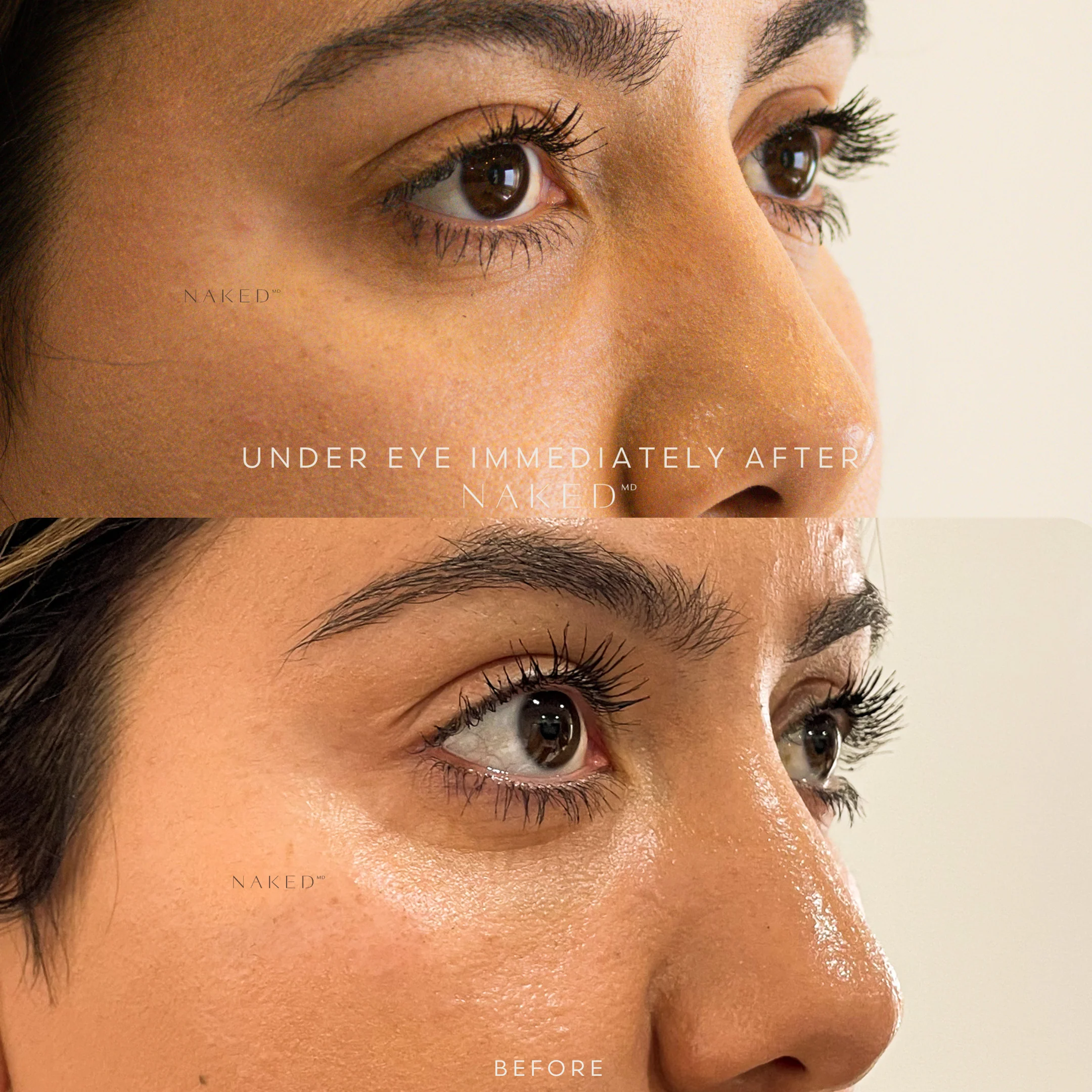 Undereye Filler - Image 5